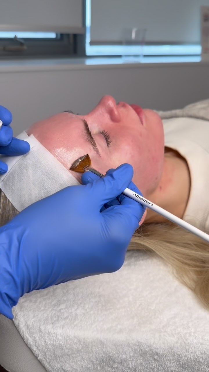 Huge thanks to @congerfitness for sharing her experience with us! ✨
Watch as Kristen documents her chemical peel journey with @beautylab.by.j here at SKIN MD. She trusted us with her skin transformation, and we’re loving her results!
Ready to reveal your glow? Book your appointment today!
#GlowFromWithin #Skincare #ChemicalPeelJourney #SkinTransformation #AlumierMD