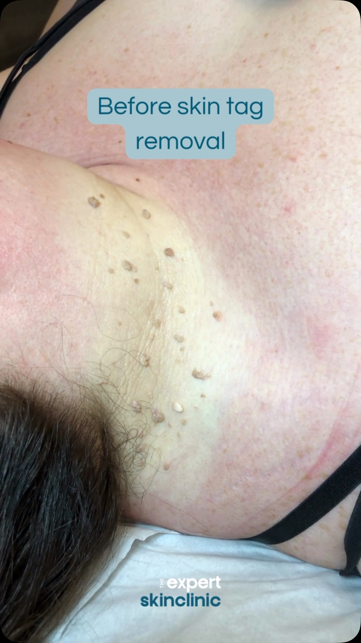 Incredible results from a recent skin tag removal🤩
This lady had a number of skin tags covering her neck. These did take a little while to heal in between sessions with multiple removals required to achieve these results but it was well worth the wait!
We’ll soon share the healing stages of this particular removal to give you an insight of what this can look like and manage your expectations.