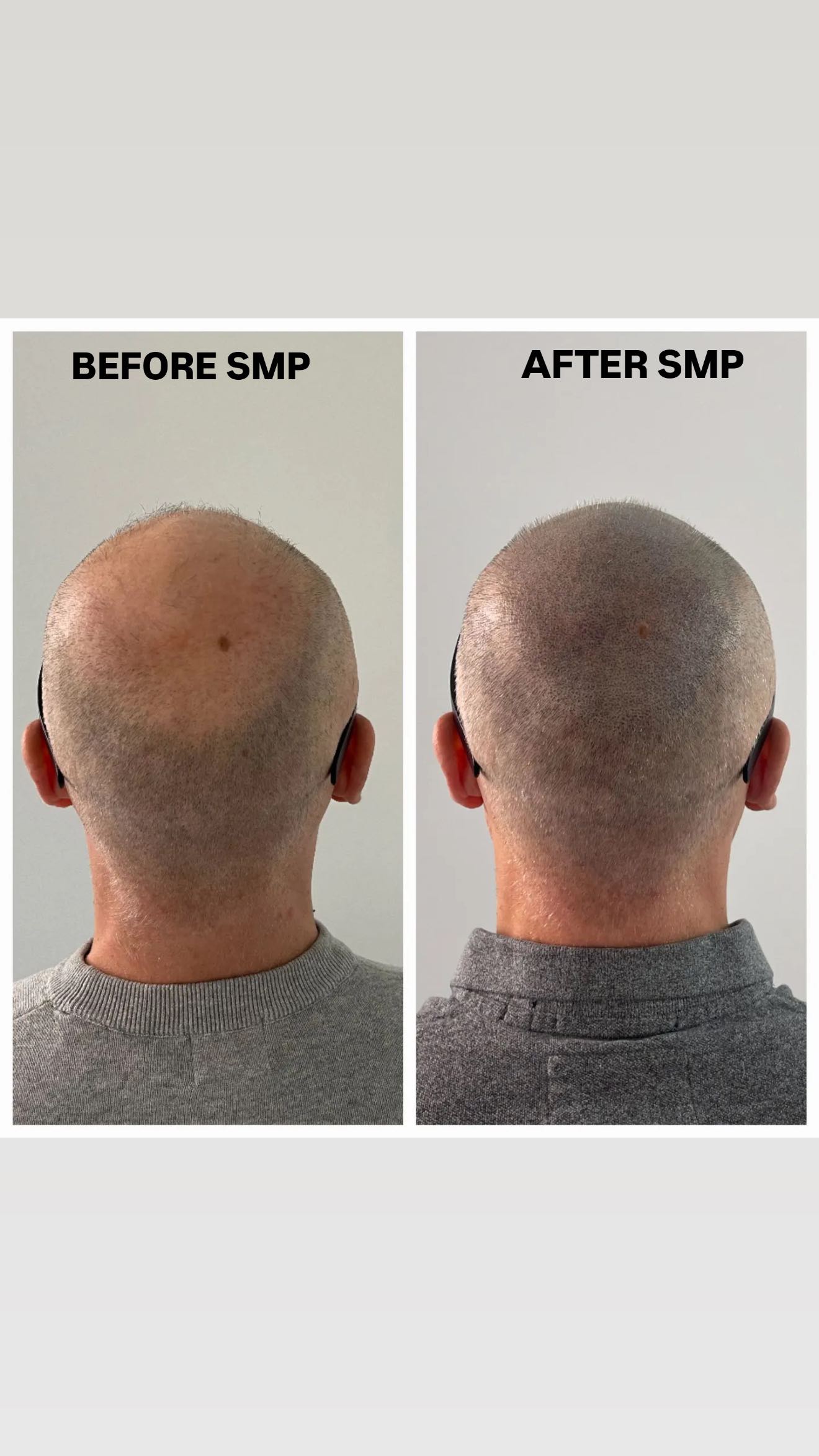 Struggling with:
– balding?
– receding hairline?
– thinning hair?
– alopecia?
I offer a natural-looking solution to hair-loss using Scalp Micropigmentation technique. 
Check these highlights on my page to solve your hair-loss problem !
—
Feel free to contact me and ask any questions about SMP. 
✅ I am Sergei Shaikhulin, your SMP expert with 4 years of experience. 
🇫🇮 I am the owner of the Certified SMP studio in Helsinki, Finland.
🗓 Book a FREE initial consultation to get:
– answers to all your questions,
– a plan of SMP for your type of hair-loss, 
– price for your case.