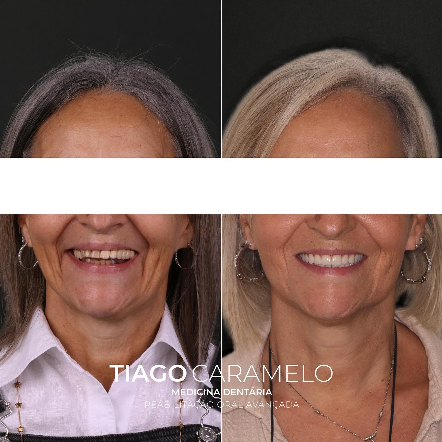 Este foi um caso especial que eu me propus a resolver a alguém que conheço há muitos anos e que estava insatisfeita com o seu sorriso e com os problemas contínuos que tem vindo a sofrer na cavidade oral ao longo dos últimos anos. De forma a solucionar a situação da clínica da minha querida paciente, foram extraídos os dentes remanescentes e colocados implantes com recurso ao protocolo All-on-4 por parte da @mariananunes.md e eu posteriormente reabilitei com uma prótese cerâmica no maxilar superior e uma prótese híbrida no maxilar inferior. A paciente voltou a ter auto-estima, vontade de sorrir e capacidade de mastigação em poucas horas.
—————————————————————————————
This was a special case that I took on for someone I have known for many years, who was unhappy with her smile and the ongoing issues she had been experiencing in her mouth over the past few years. To resolve my dear patient’s clinical situation, the remaining teeth were extracted, and implants were placed using the All-on-4 protocol by Mariana. I then rehabilitated her with a ceramic prosthesis in the upper jaw and a hybrid prosthesis in the lower jaw. In just a few hours, the patient regained her self-esteem, desire to smile, and ability to chew.
#allonfour #allonfourimplants #implantsurgery #maloclinic #malocliniceducation