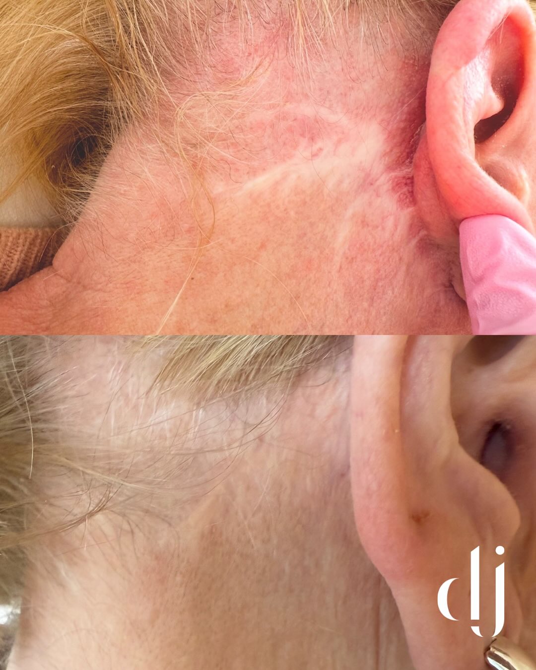 𝐅𝐀𝐂𝐄 & 𝐍𝐄𝐂𝐊 𝐋𝐈𝐅𝐓 𝐒𝐂𝐀𝐑𝐑𝐈𝐍𝐆 𝐑𝐄𝐒𝐔𝐋𝐓𝐒 𝐖𝐈𝐓𝐇 𝐌𝐄𝐃𝐈𝐂𝐀𝐋 𝐓𝐀𝐓𝐓𝐎𝐎
𝐒𝐜𝐚𝐫 𝐫𝐞𝐯𝐢𝐬𝐢𝐨𝐧 & 𝐬𝐜𝐚𝐫 𝐜𝐚𝐦𝐨𝐟𝐥𝐚𝐮𝐠𝐞 𝐭𝐚𝐭𝐭𝐨𝐨
𝐀𝐦𝐚𝐳𝐢𝐧𝐠 𝐫𝐞𝐬𝐮𝐥𝐭𝐬. 𝐌𝐞𝐝𝐢𝐜𝐚𝐥 𝐍𝐞𝐞𝐝𝐥𝐢𝐧𝐠 & 𝐌𝐞𝐝𝐢𝐜𝐚𝐥 𝐓𝐚𝐭𝐭𝐨𝐨
𝐁𝐨𝐨𝐤 𝐧𝐨𝐰 𝐟𝐨𝐫 𝐟𝐚𝐧𝐭𝐚𝐬𝐭𝐢𝐜 𝐫𝐞𝐬𝐮𝐥𝐭𝐬 𝐭𝐡𝐚𝐭 𝐚𝐥𝐰𝐚𝐲𝐬 𝐢𝐦𝐩𝐫𝐨𝐯𝐞 𝐭𝐡𝐞 𝐜𝐨𝐧𝐟𝐢𝐝𝐞𝐧𝐜𝐞 𝐰𝐢𝐭𝐡𝐢𝐧 𝐨𝐮𝐫 𝐛𝐞𝐚𝐮𝐭𝐢𝐟𝐮𝐥 𝐜𝐥𝐢𝐞𝐧𝐭𝐬
#medicalneedling #microneedling #scarcamouflage #scarcamouflage #medicaltattoo #medicalstudents #medicalpmu #pmu #pmuartist #permanentmakeup #scarremoval #scarrevision #scarreduction #skinrejuvenation #skincaretips #skinhealth #skintreatment #skingoals #skinrecovery #skinresults #skintips