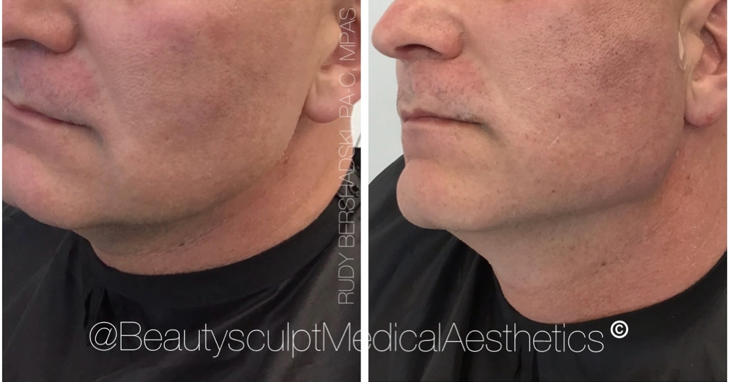 PDO threads is a nonsurgical, minimally invasive #rejuvenating procedure for skin lifting and tightening. #PDOthreads are dissolvable/absorbable threads that are placed below the skin. They are then pulled up to smooth out the skin folds and laxity. PDO threads are commonly used on face and neck.
Are you ready for your “SNATCHED” look? Call (239) 777-5002 for your complimentary consultation.
.
.
.
.
#beforeandafter #skinlift #naplesmedspa #medicalaestheticsnaples #naplesPDOThreadsCenter