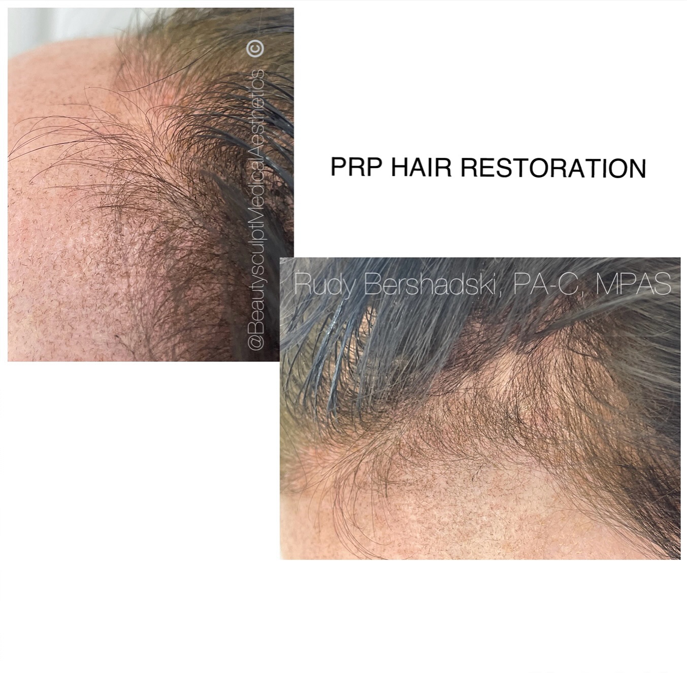 Losing hair? Noticing finer hair? Receding hairline?
PRP hair restoration is a treatment that uses a sample of your own blood to obtain platelets to stimulate hair growth. Evidence has shown that after interval series of treatments and maintenance, improvement in hair health and stimulation of regrowth is noted.
Ready for a complimentary consultation? 📞 239-777-5002
.
.
.
.
#PRPNaples #hairrestorationnaples #naplesmedspa #rejuvenate #PRPhairrestoration #medicalaestheticsnaples