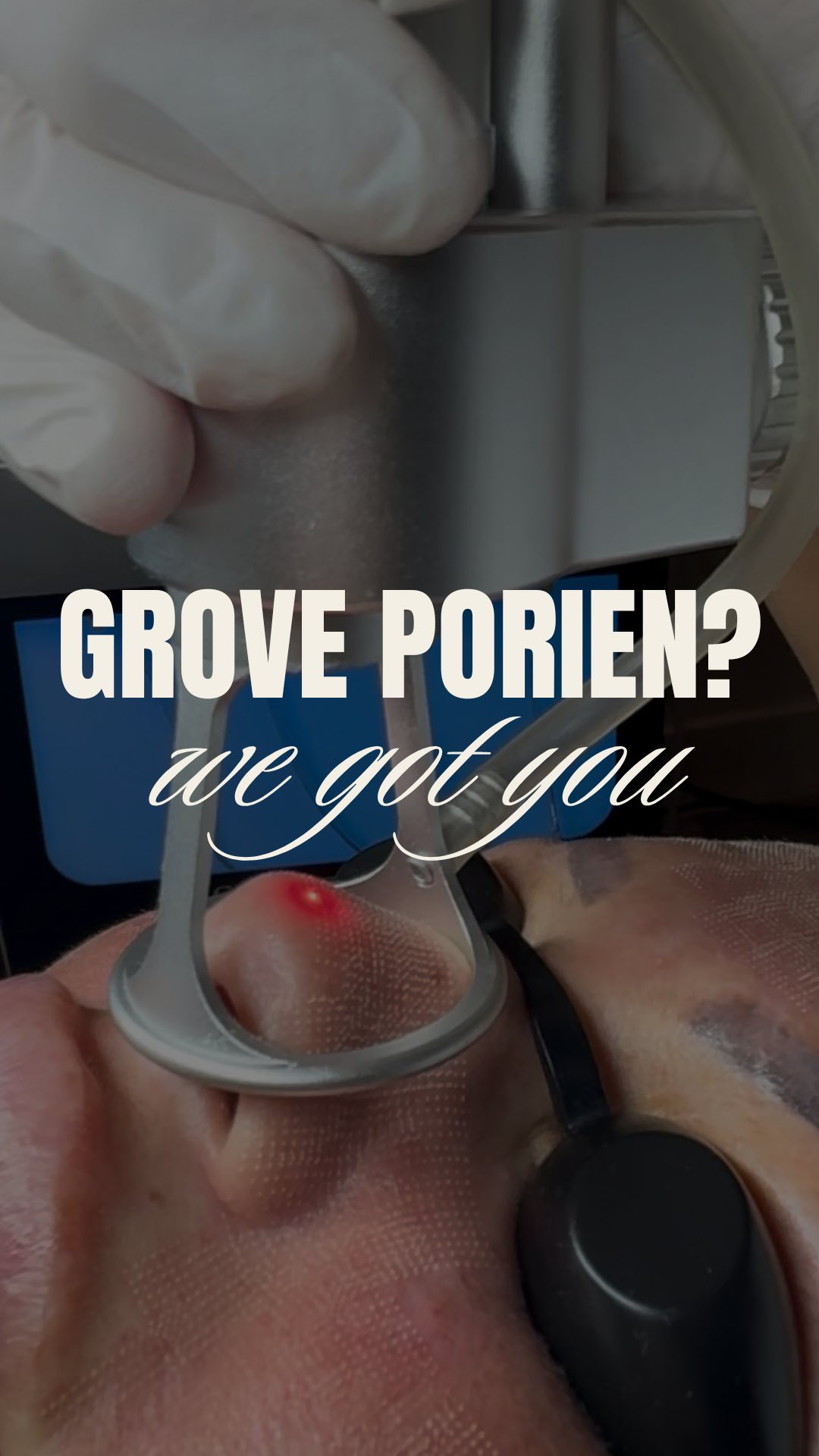 Elke keer weer die spiegel… en daar zijn ze weer. Die grove poriën op je neus, die je huid onrustig laten lijken, hoe goed je skincare ook is. 😩 Je probeert alles – exfoliëren, maskers, poriestrips – maar ze blijven zichtbaar.
We feel you. En we GOT you. ❤️🤝
Wist je dat de CO₂ Classic hier perfect voor is? 💡 Dit is dé oplossing als je specifiek jouw neus aan wilt pakken. Met slechts één gerichte behandeling verfijnt het je poriën, maakt het je huid gladder en geeft het je die frisse, verfijnde look waar je zo naar verlangt. ✨
Tijd om afscheid te nemen van frustratie en hello tegen een smooth skin. Let’s glow! ✨💖
Stuur ons een bericht met “INFO” voor meer details of om direct te boeken.
- Alles wat je nodig hebt, vind je via de 🔗 in onze bio.
Boek online een afspraak: www.thehagueclinic.nl
📞 Bel: 085 060 74 77
📧 E-mail: info@thehagueclinic.nl
LIKE, SAVE & FOLLOW als jij klaar bent voor jouw huidtransformatie.
🤍 @thehagueclinic
#co2behandeling #huidkliniek #huidkliniekrotterdam #huidkliniekamsterdam #populairebehandeling #acnebehandeling #groteporien #groveporieën #meeeters #bestehuidbehandeling #huidtherapie #huidtherapeut #schoonheidsspecialiste #schoonheidssalon