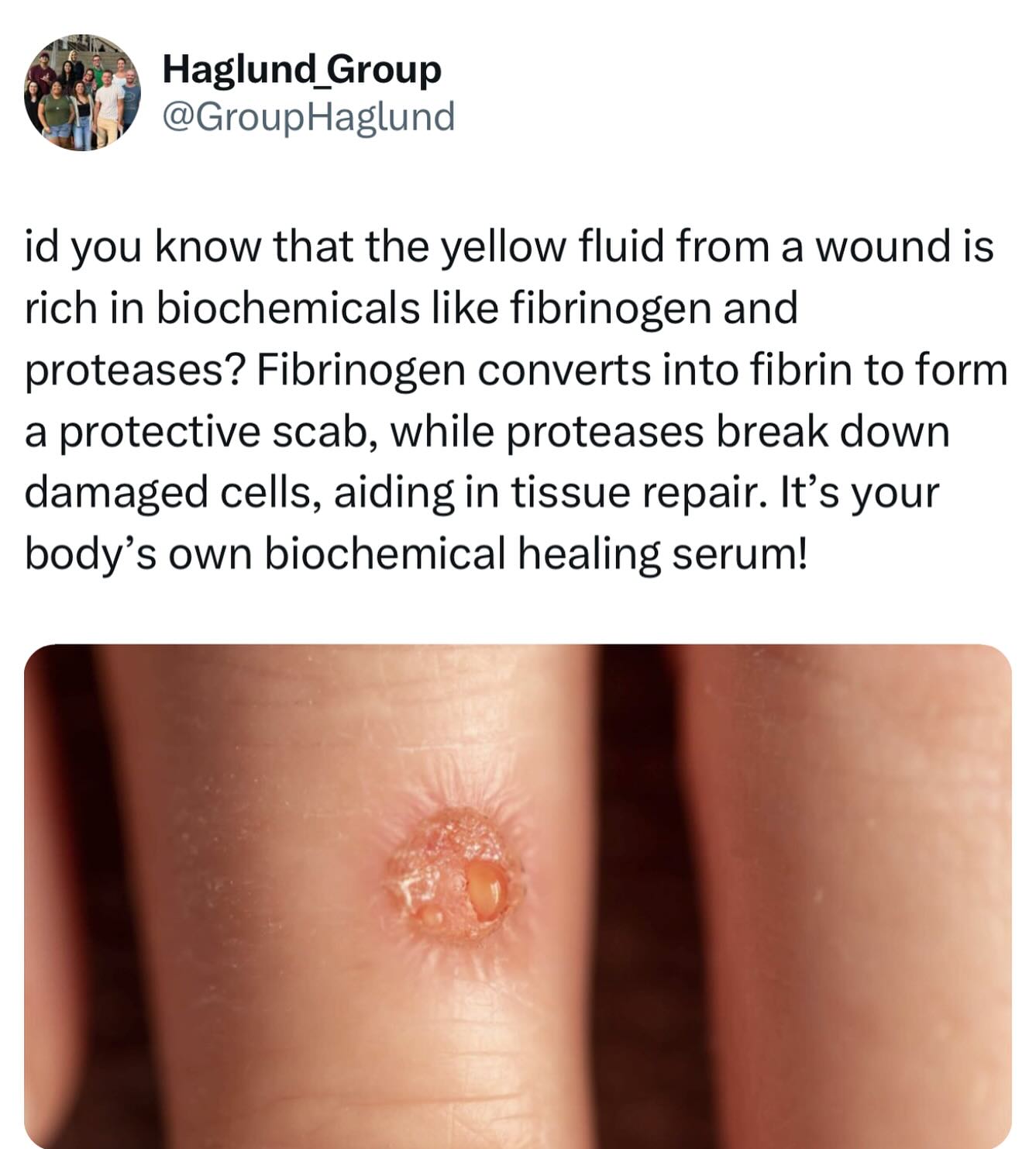Did you know that the yellow fluid, aka serous fluid, from a wound is rich in biochemicals like fibrinogen, albumin, and proteases? Fibrinogen converts into fibrin to form a protective scab, while proteases break down damaged cells, aiding in tissue repair. It’s your body’s own biochemical healing serum!
#biochemicalhealing #woundhealing #funfacts #funfactfriday #funfact #scientificfacts #hawaii #universityofhawaiiatmanoa #uhm #universityofhawaiia #uh #science #DNA #chromosomes #researchgroup #haglundgroup #drhaglund