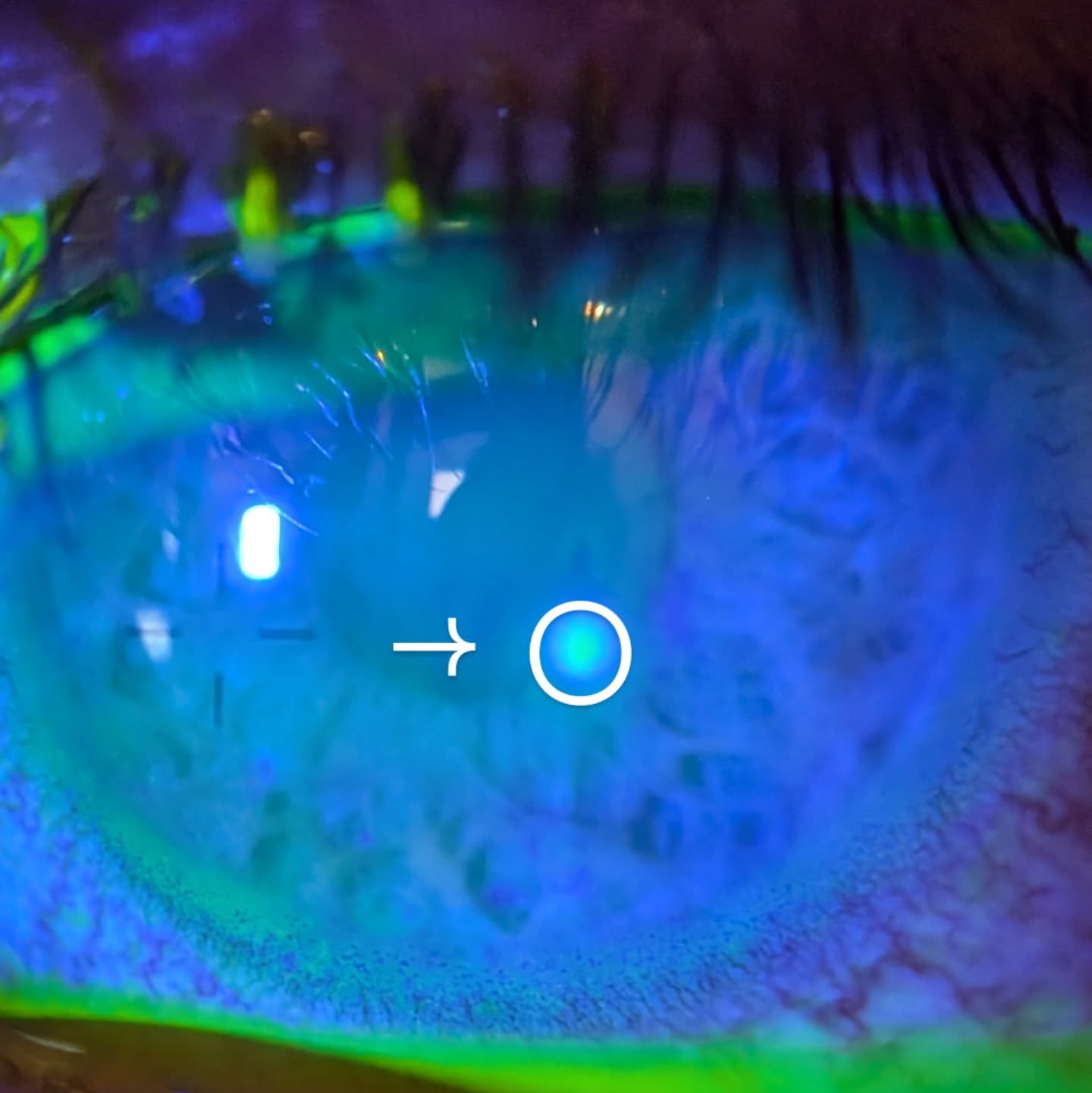 The highlight of my week - brought to you by sleeping in contacts!
Contrary to what Nike says - Just DONT do it.
#painfulwye #cantbreath #travelingeyedoc #newbergfamilyeyecare #newbergeyes #sherwoodeyes #eyedoctorsarefun