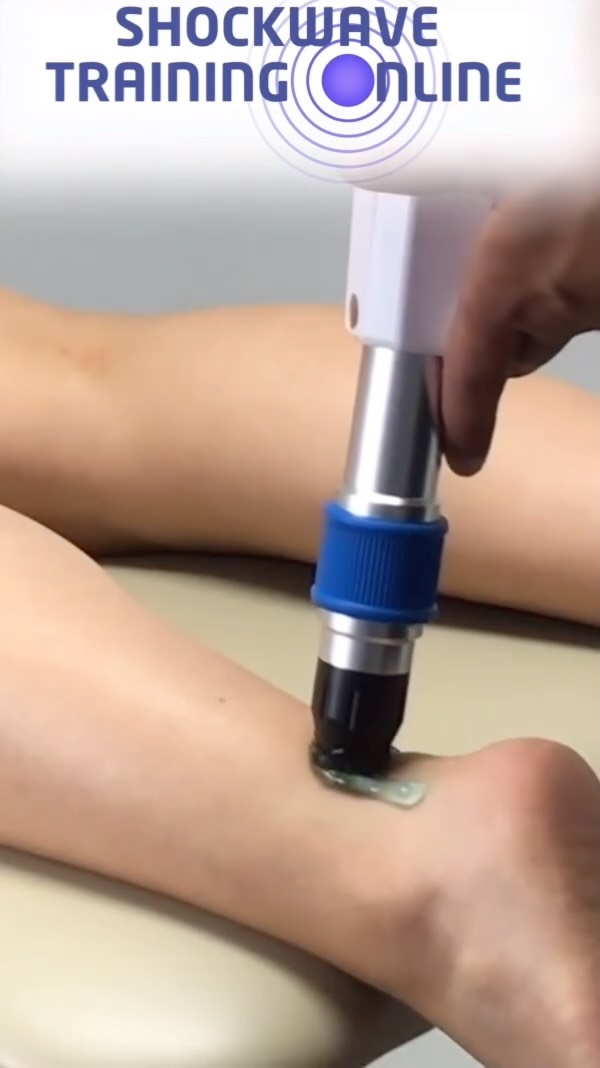 💥 Beat Stubborn Achilles Tendinopathy with Shockwave + Progressive Loading 💥
Dealing with stubborn Achilles tendinopathy that just won’t improve with time or rehab alone? You’re not alone—and there’s a solution.
Shockwave therapy, when paired with a progressive loading program, can break the cycle of pain and dysfunction. Shockwave reduces pain, stimulates healing, and promotes tissue regeneration, making it the perfect complement to structured tendon loading. Together, they help patients get back to pain-free activity faster.
Our online course teaches you how to integrate shockwave therapy into your treatment plans seamlessly, giving you the tools to tackle even the most persistent cases with confidence.
📚 Ready to elevate your practice? Enroll today!
#ShockwaveTherapy #AchillesTendinopathy #TendonRehab #ProgressiveLoading #SportsMedicine #Physiotherapy #PhysicalTherapy #Rehabilitation #HealthcareProfessionals #ShockwaveCourse #TherapyMadeSimple