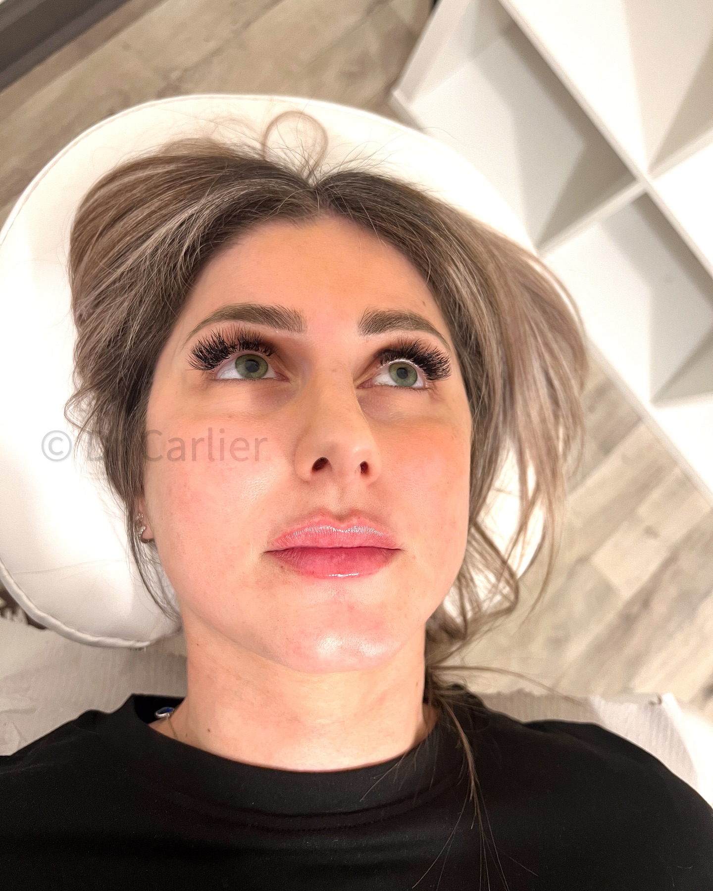 🫦 Lèvres Sublimées avec l’Acide Hyaluronique ✨
💉 Hydratation, volume & contour parfait
⏳ Résultat naturel et harmonieux
🔗 Révèle la beauté de ton sourire
#LipsGoals #AcideHyaluronique #LèvresPulpeuses #BeautyEnhancement