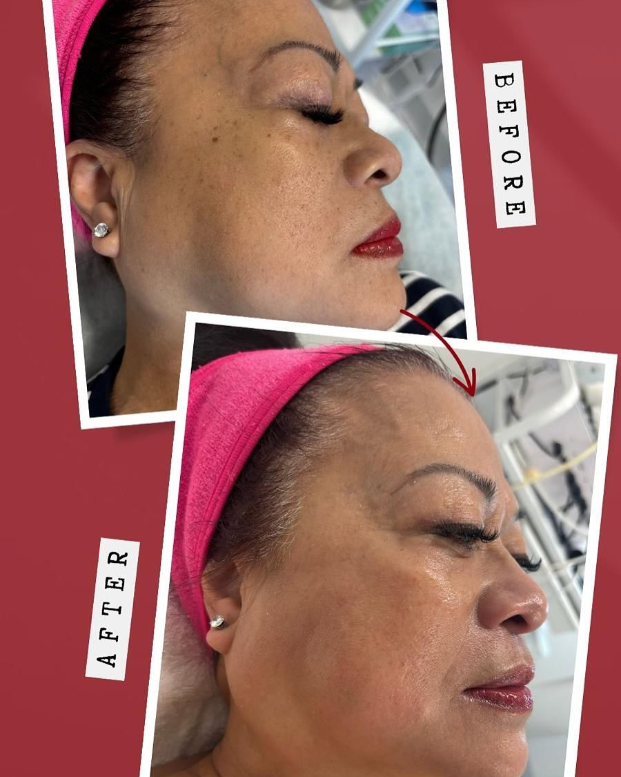 Glow unlocked! ✨ Just 1 PicoSure treatment + 1 LaseMD Ultra, and the results speak for themselves! Brighter, smoother, and more radiant skin in no time. Who’s ready for their glow-up? 💖
@cynotroniccam
@cynosurelasers
@cynosurecanada
#SkinGoals #PicoSure #lasemdultra