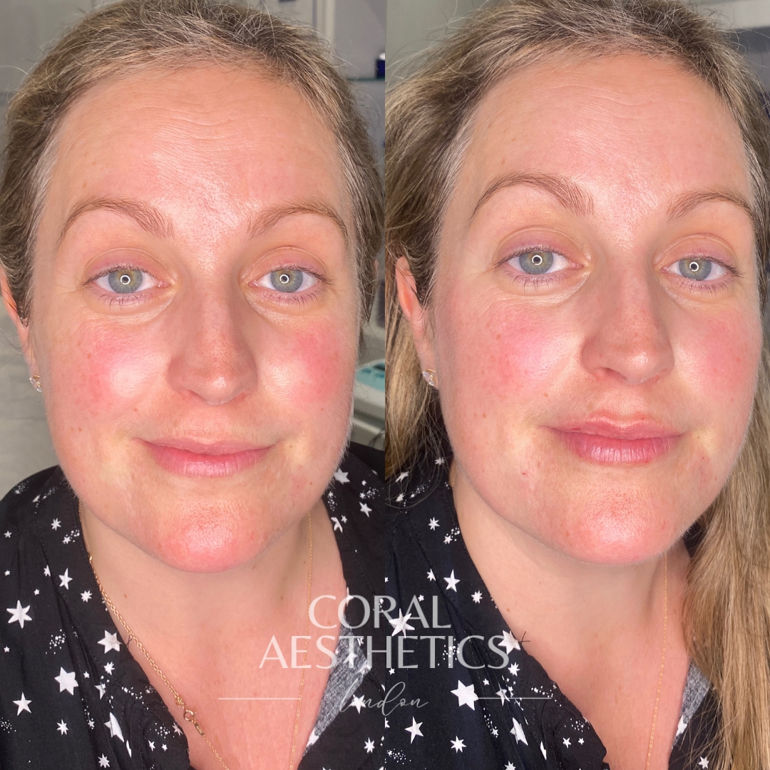 Guess the subtle treatment that makes a difference!
Lip filler is a treatment that can be customised to you. Whether you're looking for hydration, definition or volume, this treatment is 100% personalised.
The best part is that whilst you'll notice a difference, results can be undetectable - nobody needs to know that you've had treatment!
Get in touch today to schedule your lip filler consultation, we can't wait to hear from you.
📍London | Essex | Kent
👩🏽⚕️Experienced Nurse Prescriber
⭐️5 Star Reviews
💻Online Booking Open
#essexskinclinic #dermalfillerskent #lipfillerlondon #lipfillerkent #aestheticsashford #eastlondonclinics #nursepractitioner #medicalaesthetics #maililips #naturallipfiller #liphydration #naturalresults