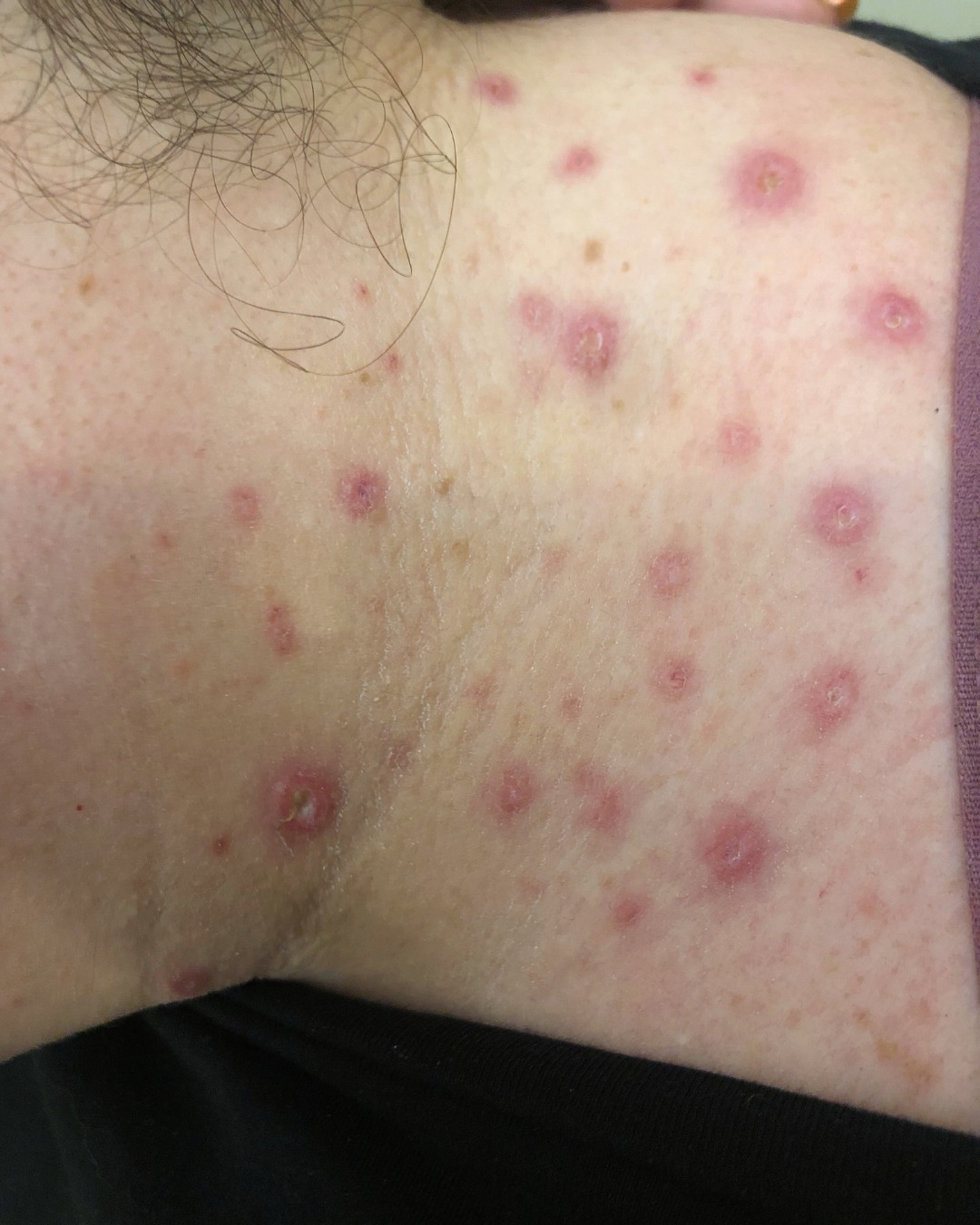 With blemish removal, you have to trust the process!
As you can see, this client went through various healing stages before getting perfect results. Everyone reacts and heals differently from skin treatments so please do bear this in mind and set your expectations when getting blemishes removed.
If you scroll to the end to the final picture, you'll see this client had a number of skin tags covering her neck that required multiple sessions with healing time in between to achieve the final results.
We'll discuss this all with you and let you know predicted healing time in your initial consultation.