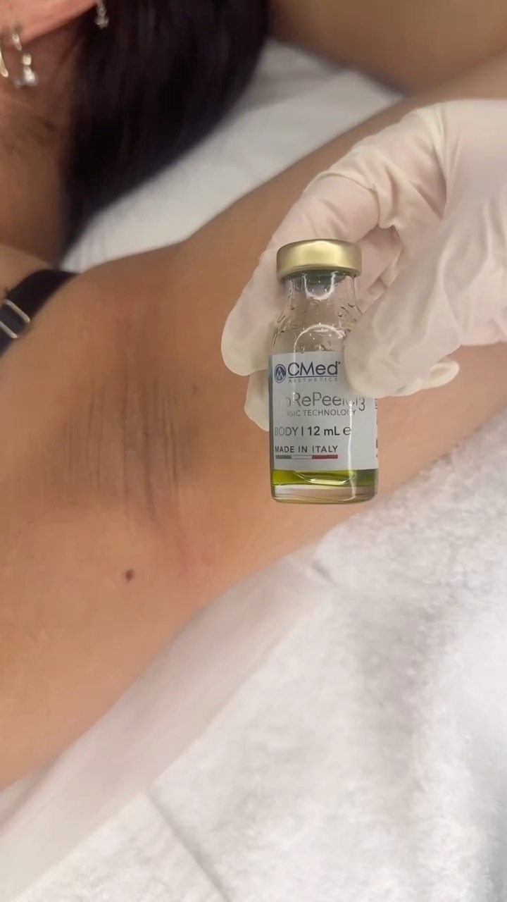 Brighten up & feel confident in your skin! ✨
BioRePeel is the perfect solution for reducing hyperpigmentation in areas like underarms and intimate areas. This gentle yet effective treatment evens out skin tone, revealing smoother, brighter skin with no downtime!
Say goodbye to dark spots - book your BioRePeel today!
#BioRePeel #GlowFromWithin #HyperpigmentationFix