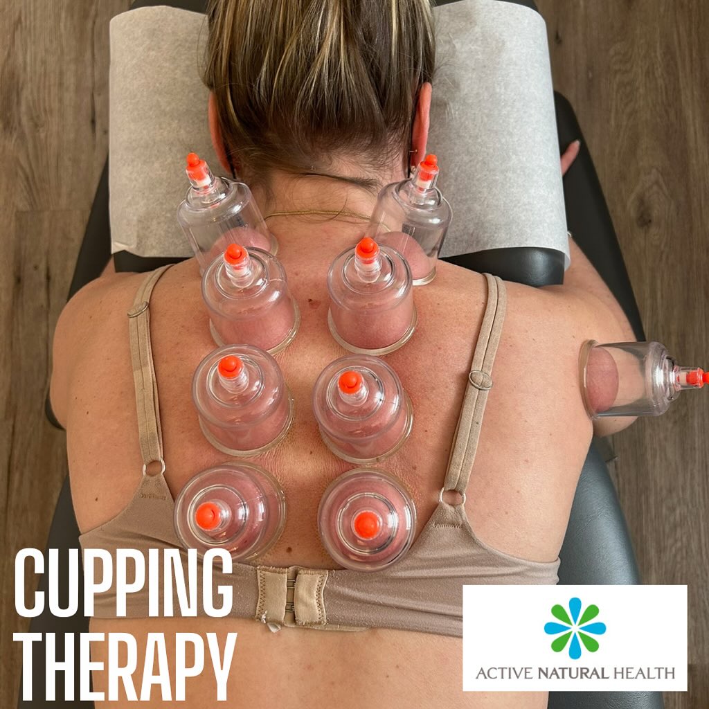 Benefits of Cupping:
โ
reduction of pain
โ
decrease in muscle tightness
โ
increase in range of motion
โ
increase in blood flow