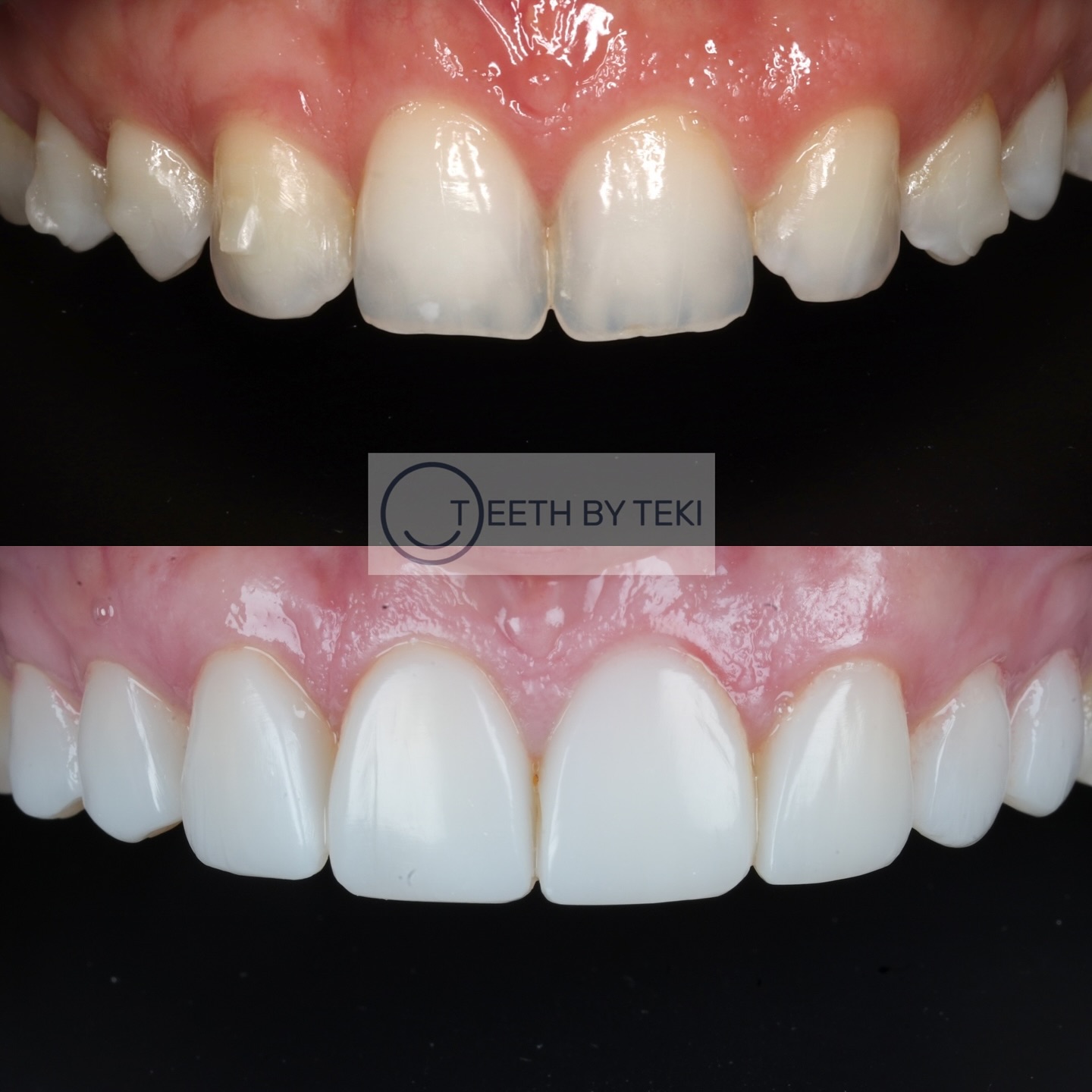 A lot happens in 6 years …
I met this lovely patient 6 years ago. She had missing teeth (where the blue arrows are) and needed them straightened. She wanted to improve her smile and not have down her teeth. She loved them and I didn’t see her for years.
She came back to me this year as she was getting married. She was still happy with her composite but wanted to see what could be done to make them look better. I suggested we do some laser gum shaping on two teeth (pink lines) to make the gum lines more even and redo the composite to make them brighter.
I love this case because seeing my patients for years and sharing happy times with them is amazing and it also shows how things have progressed with composite. Based on how she looks after them and the maintenance plan we have now they should last even longer.
It’s exciting to see where things will be in 6 years from now. Thank you to all my patients who keep coming back after all these years 💙
#teethbyteki #compositebonding #healthyteeth