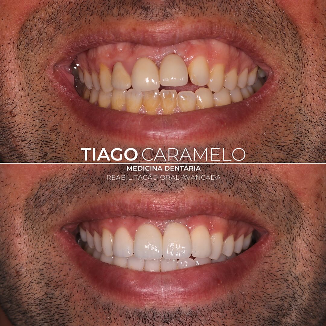 Trago-vos mais um caso de um dos meus melhores amigos que estava insatisfeito com a estética das coroas cerâmicas realizadas há uns anos atrás. Há muito que tem vindo a adiar este tratamento, mas finalmente decidiu e procedemos então a uma substituição das coroas sobre os dentes 11 e 12 e da coroa do implante 21. Foi igualmente realizada uma faceta no elemento 22 e um branqueamento dentário em ambulatório. Agora sim, pode voltar a sorrir sem qualquer limitação!
Trabalho laboratorial realizado por @anabelasilvacerqueira
—————————————————————————————
Here’s another case of one of my best friends, who was dissatisfied with the crowns done a few years ago. He had been postponing this treatment for a long time, but he finally decided to go ahead, so we proceeded with the replacement of the crowns on teeth 11 and 12, as well as the implant crown on tooth 21. A veneer was also placed on tooth 22, and an at-home teeth whitening treatment was performed. Now, he can smile again without any limitations!
Laboratory work by @anabelasilvacerqueira
#ceramics #ceramiccrowns #ceramicveneers #bleaching #oralhealth #aestheticdentistry