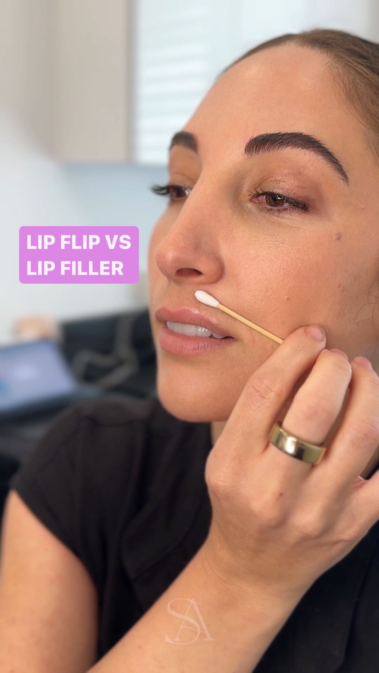 👄Lip Flip vs. Lip Filler: Enhancing Your Pout
Let’s discuss the benefits of a lip flip versus lip filler for enhancing the lips. The key differences are that a lip flip lifts the lips by relaxing the muscle from turning inward, while filler adds volume.
#lips #lipflip #lipgloss #perfectpout #lipinjections