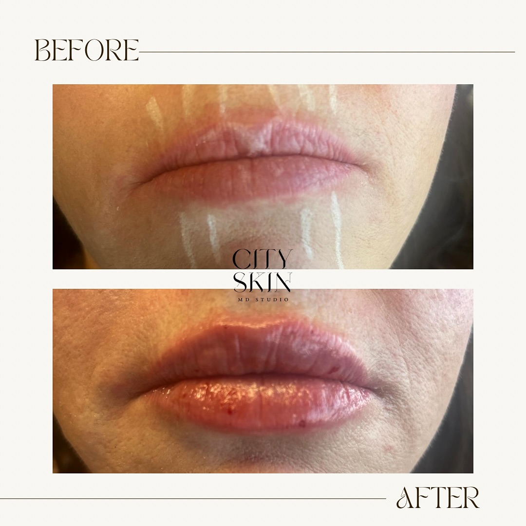 Lip fillers can help you get the shape, volume, and definition you’re looking for. Whether you want a subtle, natural enhancement or a fuller, more dramatic look, at cityskinmds we can tailor the results to your goals.
It’s important to have a consultation first so we can discuss the style you want, like added volume, a more defined cupid’s bow, or just a little hydration and smoothness. The right technique and type of filler make all the difference in getting the lips you desire. Book a consultation now at cityskinmds.com or DM me. 👄✨ #cityskinmds #lipfillersbeforeandafter #lipgoals #beautyobsessed #cosmetics #supportsmallbusiness #smallbusinessowner