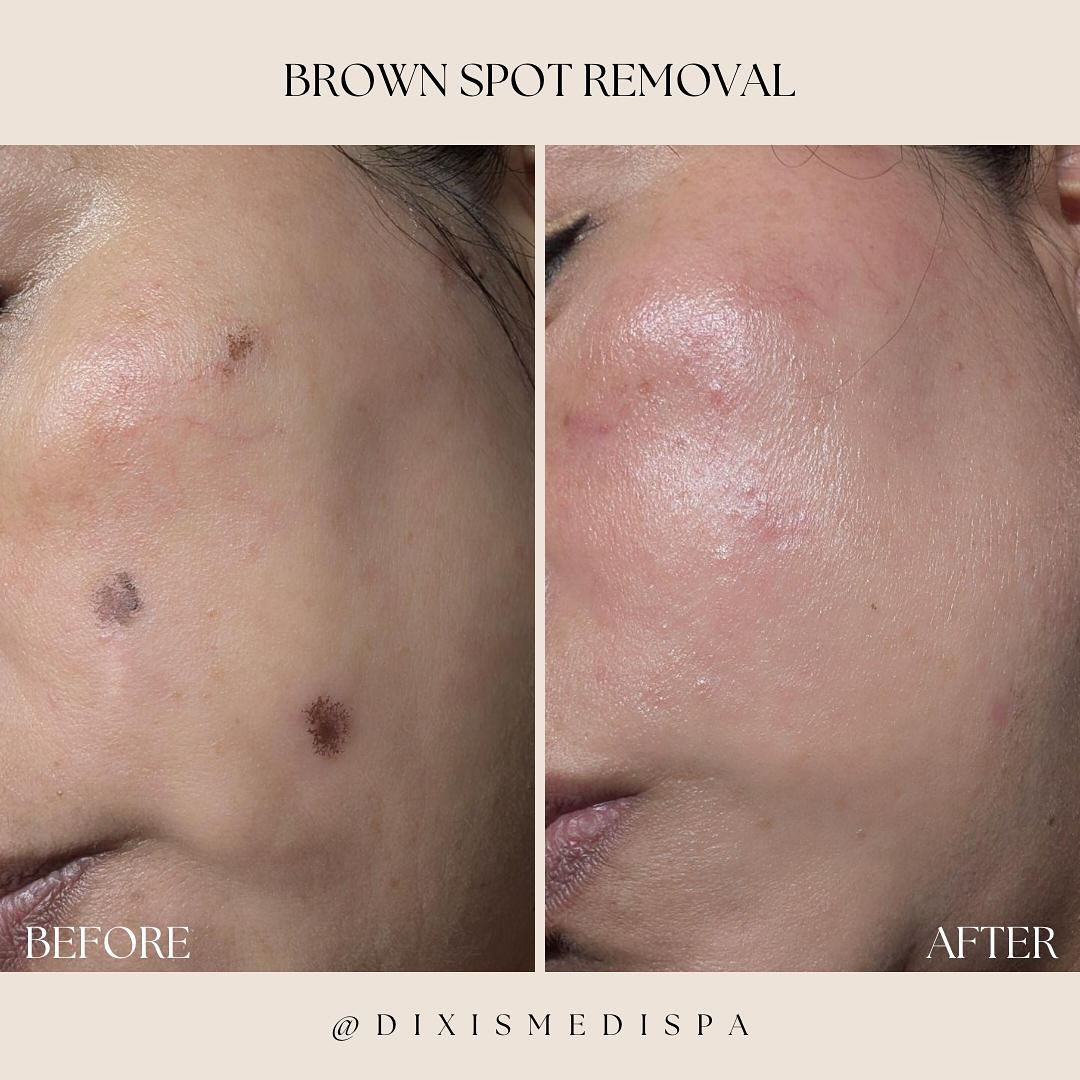 Say goodbye to sunspots! 🤩Check out this amazing transformation after just one session of laser removal. #LaserRemoval #BrownSpotRemoval #CandelagentlemaxProPlus”
