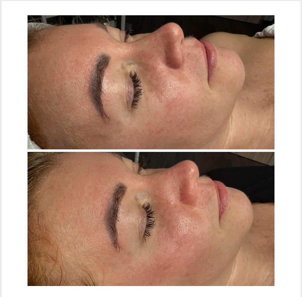 #neosino #treatment #beautifulskin @fashionbeauty_szepsegszalon