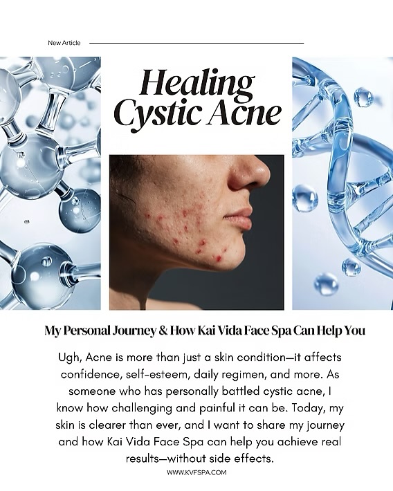 Check out the new blog post on our website! Here’s a little preview! Link in bio!
Professional acne treatments at Kai Vida Face Spa. 🧖♀️
If you’re struggling with painful, persistent acne, know that healing is possible—without the harsh side effects. Clear, healthy skin is within reach, and we’re here to help you get there!
Your skin deserves real results.
#KaiVidaFaceSpa #CysticAcne #acne #AcneSkincare #skincare #Facials #facespa #glowingskin #SkincareRoutine #RealSkinRealResults