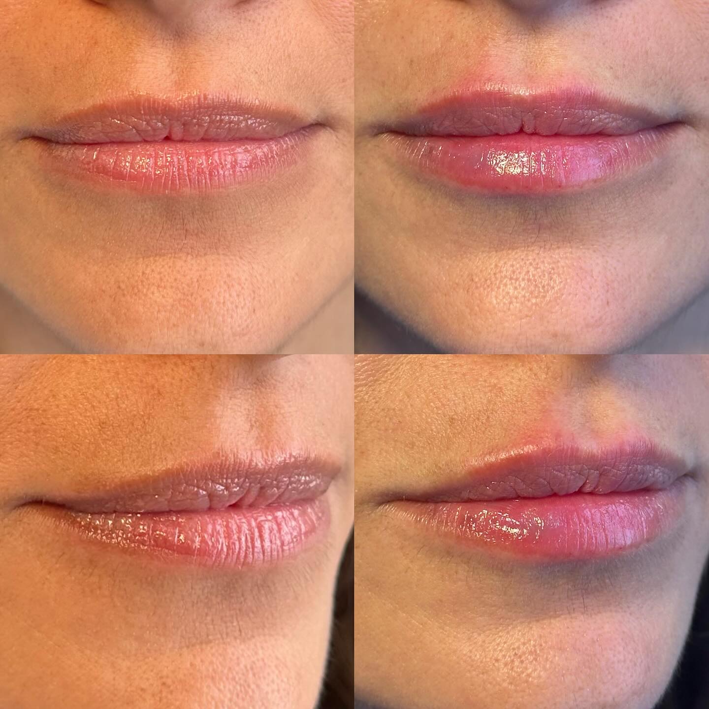 Soft hydration and plump using Restylane Kysse ❤️
#lipfillerlondon #naturallipfiller #naturalaesthetics #aestheticslondon #juliehornelipslondon
