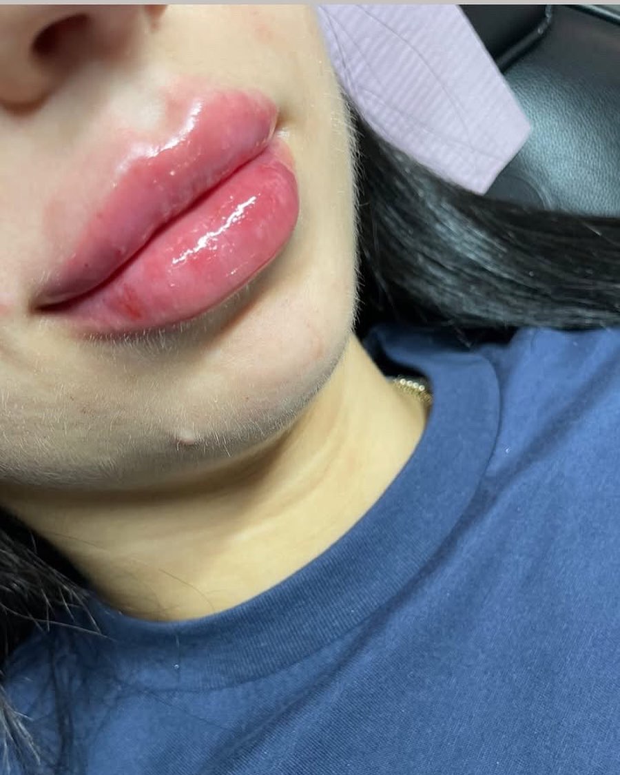 Gorgeous lips perfect for spring 💐 1.5mL was injected #lipfiller #hyaluronpentraining #lipinjections #tampalipfiller #sarasotalipfiller #facialbalancing #microneedlefiller #explore