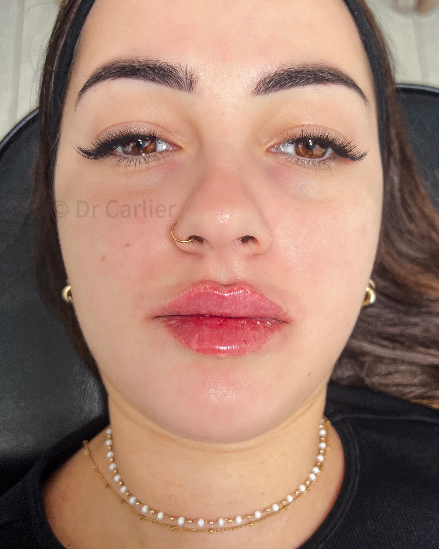 ✨ Russian Lips ✨
Un arc de Cupidon parfaitement dessiné, une bouche glamour et harmonieuse… Voici la magie des injections bien maîtrisées ! 👄💉
Parce qu’une belle bouche ne se résume pas qu’au volume, mais aussi à l’art de sculpter chaque courbe avec précision. Résultat ? Une bouche sensuelle et équilibrée qui sublime le visage sans jamais en faire trop.