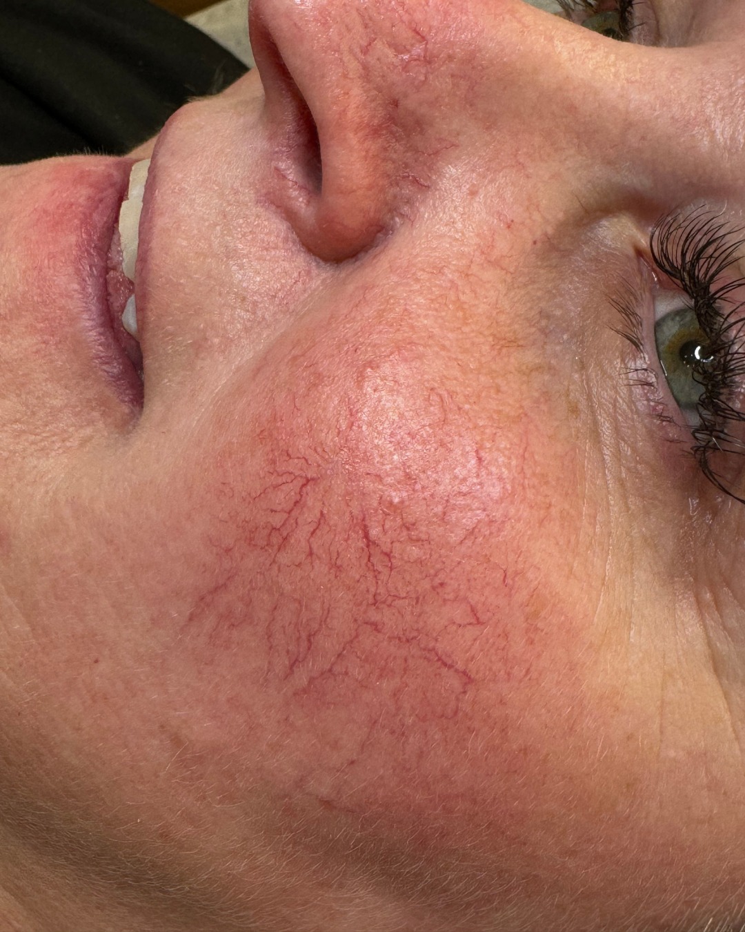 An insight into thread vein removal results after just 2 treatments🤩
Threads veins commonly appear around areas like the nose, cheeks and chin. They are small blood vessels that become visible and are typically red or purple in colour. There's lot of reasons why they may appear including age, sun exposure, hormones or just genetics. They are harmless but easy to remove if you'd prefer to!
These before and after pictures were taken after just 2 treatments, with 6 weeks healing time in between each treatment. With a treatment like this, we can only work on the skin for so long before it becomes very red meaning we then can't accurately see the veins to work on.
For this reason, thread veins can require a few treatments so patience is key. This lady in particular has some bigger thread veins and some smaller ones. We start with the bigger ones but typically have to wait for the skin to heal before going in and treating the smaller ones. You can see the reduction in the final picture but she will require another treatment.
Stay tuned for the final result and head to our website if you want to get your own thread veins removed!