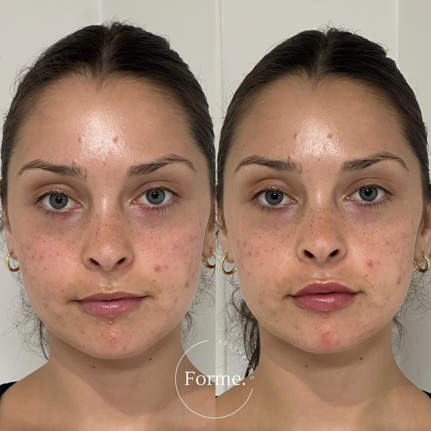 Clinic hours
Monday: 1-5pm
Tuesday: 12-6pm
Thursday: 12-6pm
Friday: 11-4pm
Later evening appointments taken by request.
Any surgical or invasive procedure carries risks. Before proceeding, you should seek
a second opinion from an appropriately qualified health practitioner. Results vary.
Consent is always obtained before sharing patient images.
Treatment performed by Stephanie Sirillas RN