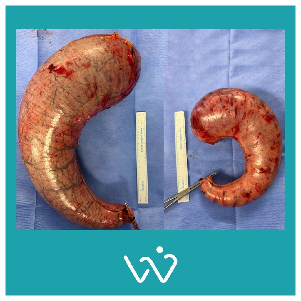 هذه الصورة للجزء المزال من المعدة أثناء عملية التكميم لمريضين مختلفين. رغم إستخدام أنبوب قياس موحد لضمان معدة متبقية ذات مقاس ثابت فإن الجزء المزال يختلف بالحجم. للعلم المعدة الأكبر كانت للمريض ذو الكتلة الأصغر. والمعدة الأصغر كانت للمريض ذو الكتلة الأكبر. صحتك تهمنا. صحتك تهمنا. #د_وليد_مال_الله #تكميم #بالون #أوزمبيك #مونجارو.
.
.
.
.
د. وليد مندني مال الله
MB, BCh, BAO(NUI), LRCP &SI, DABS, Dipl. of ABOM, FACS, FRCSC
إستشاري جراحة عامة و سمنة و مناظير
خريج كلية الجراحين الملكية بأيرلندا (مرتبة الشرف)
البورد الأمريكي في طب السمنة
البوردين الأمريكي و الكندي في الجراحة
الزمالة الأمريكية و الكندية في الجراحة
واتساب الحجز - 1886633 / 99887575