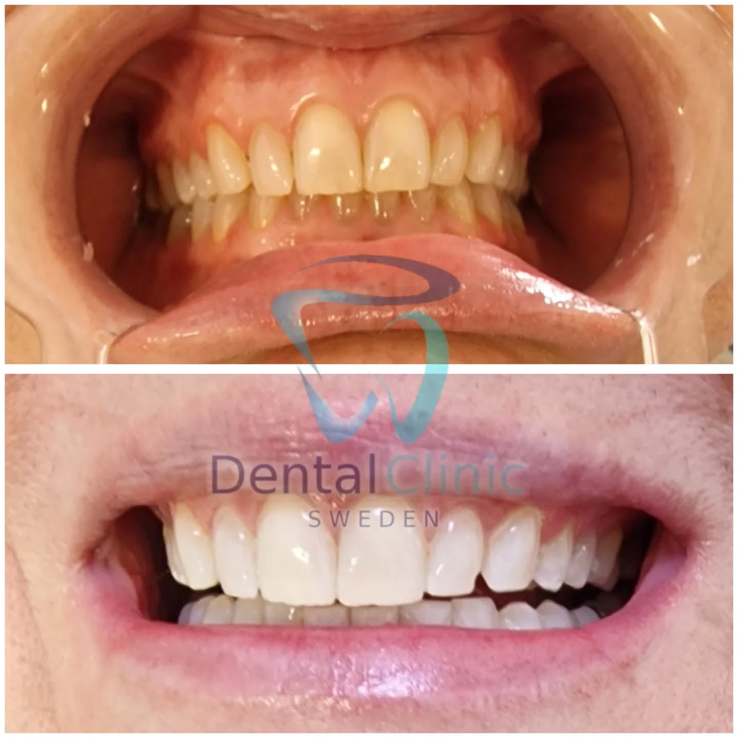 Klinik Tandblekning 
ERBJUDANDE 995 KR (Ordinarie pris 4900 kr)
ONLINE TIDSBOKNING
www.DentalClinicSweden.org🔺️
 #tandblekningstockholm #TandblekningStockholm #tandblekning #tandsmycke #tandsmyckestockholm #stockholm #liljeholmen #KlinikTandblekning #TandblekningGöteborg #TandblekningUppsala #TandblekningUtbildning #fillers #fillersstockholm #fillersgöteborg #fillersmalmö #TandblekningsUtbildning #fillersstockholm #russianlipsstockholm