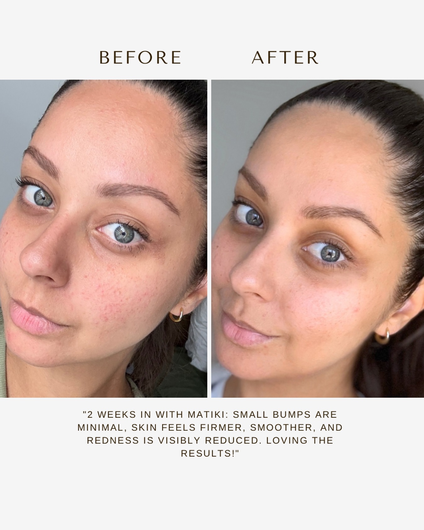 Two weeks. One serum. Unbelievable results! â¨
If you havenât tried Matiki Skinâs Revive and Replenish serum yet, this is your sign! Powered by Matico, a centuries-old healing plant, this collagen-boosting, hydrating serum is transforming skin naturally.
â
Redness? Fading fast.
â
Texture? Smoother than ever.
â
Hydration? Deeply restored.
â
Glow? Next level.
Maticoâs anti-inflammatory and skin-repairing properties work like magic! Soothing irritation, strengthening the skin barrier, and revealing a clearer, healthier complexion.