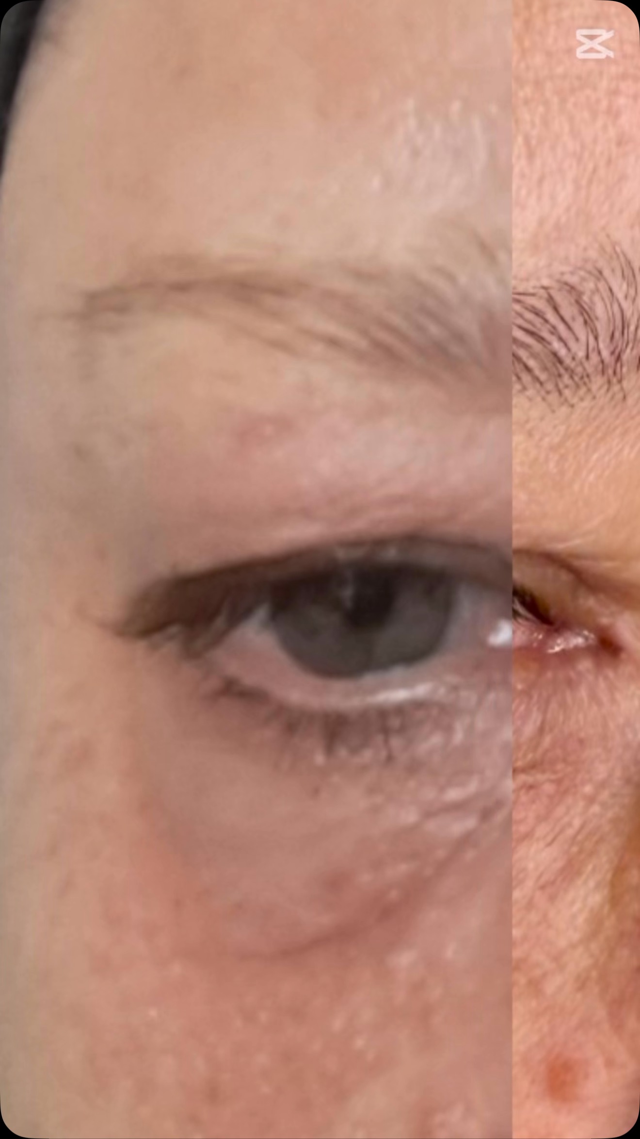 ✨ The Magic of Plasma Fibroblast ✨
Experience the incredible skin-tightening power of Plasma Fibroblast! This revolutionary treatment:
✅ Lifts and tightens loose skin
✅ Smooths out wrinkles
✅ Brightens skin by reducing pigmentation
✅ Rewinds signs of aging for a fresher, younger look
One of the few non-surgical treatments safe for delicate areas like the eyes!
📸 This client’s results are just 2 weeks post-treatment—final results develop over 12 weeks to 6 months! Why? Because fibroblasts activated during the procedure continue producing new collagen, firming and lifting the skin naturally over time.
Ready to remember the younger you again? ✨
DM us to book your consultation today!
#PlasmaFibroblast #SkinTightening #WrinkleReduction #CollagenBoost #NonSurgicalLift #YouthfulSkin #SkinRejuvenation #AntiAging #GlowUp #AgelessBeauty #TightenAndLift #FibroblastTreatment #PlasmaSkinTightening #FreshFace #SkinTransformation #BeautyInnovations #IllawarraSkin #WollongongSkin #LaBelleSkinTherapy