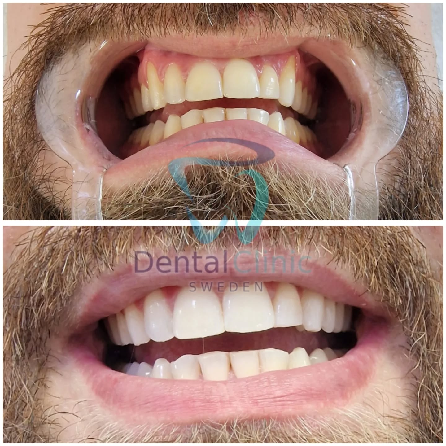 Klinik Tandblekning 
ERBJUDANDE 995 KR (Ordinarie pris 4900 kr)
ONLINE TIDSBOKNING
www.DentalClinicSweden.org🔺️
 #tandblekningstockholm #TandblekningStockholm #tandblekning #tandsmycke #tandsmyckestockholm #stockholm #liljeholmen #KlinikTandblekning #TandblekningGöteborg #TandblekningUppsala #TandblekningUtbildning #fillers #fillersstockholm #fillersgöteborg #fillersmalmö #TandblekningsUtbildning #fillersstockholm #russianlipsstockholm