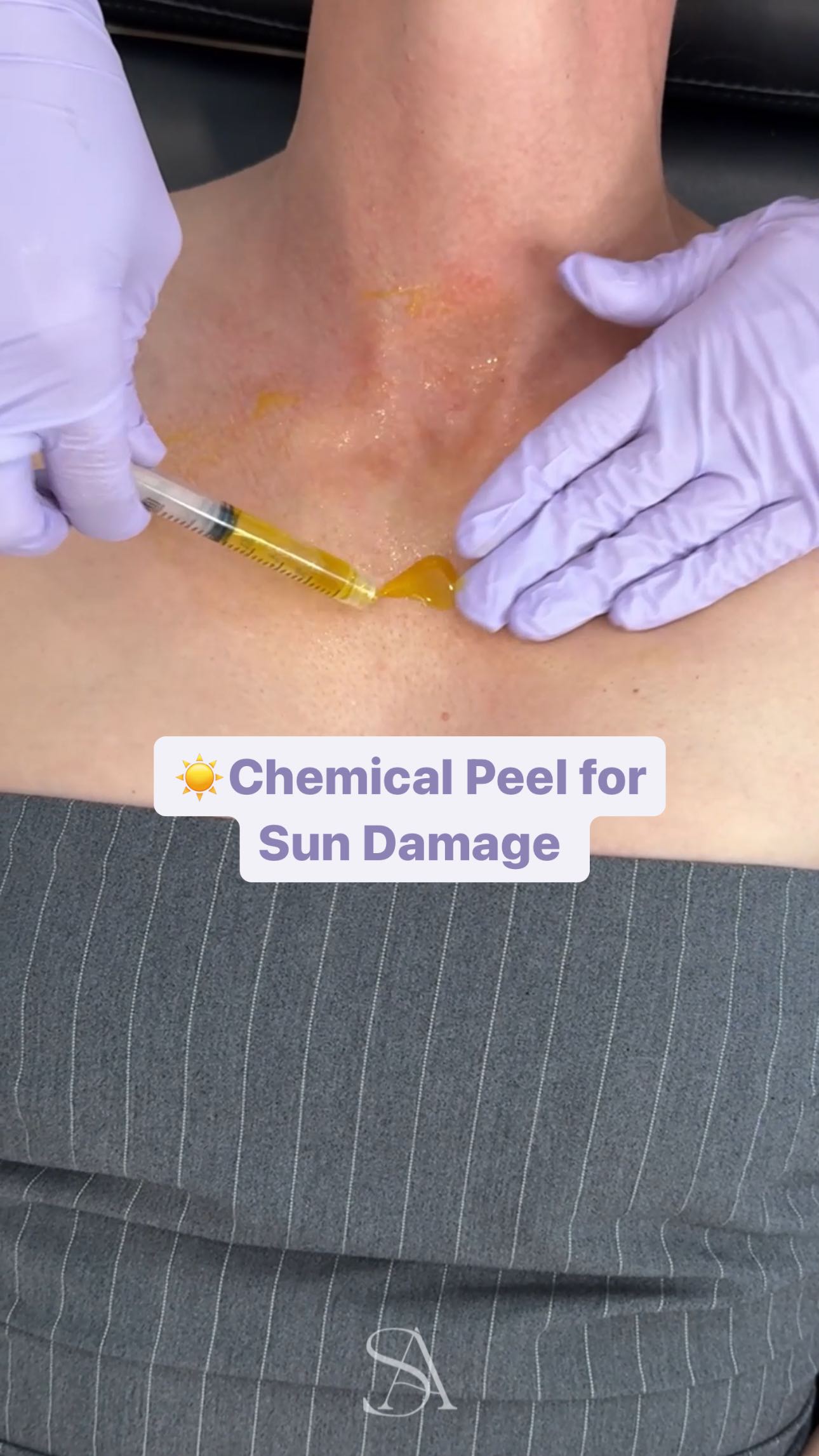 ☀️Addressing sun damage on the chest with a minimal downtime chemical peel.
💡Redness, textural changes, lines, and brown spots are all common signs of sun damage that can be treated effectively with a chemical peel, providing a quick, painless, and low-downtime solution.
#chemicalpeel #peel #skincare #hyperpigmentation #skintips