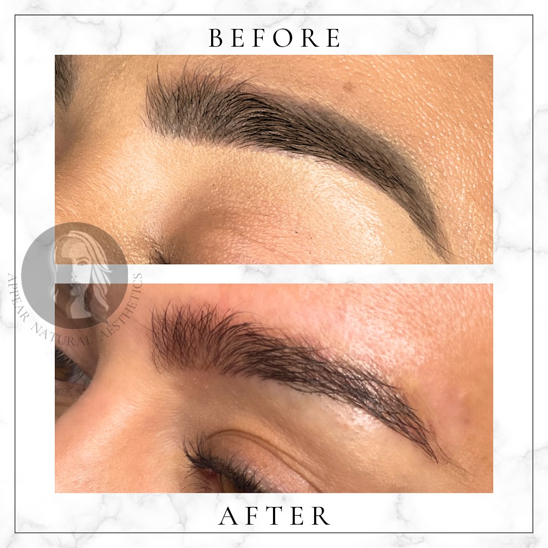 .
ððš ð¡ðð§ðšð¥ðð.
My client came to me because she disliked the eyebrow tattoo she had done a few years ago. I carried out 2 sessions of laser removal & achieved fantastic results. Now that the dark ink has been removed, her beautiful natural brows stand out perfectlyâŠ. Iâve certainly got brow envy! â¡
Eyebrow tattoo removal is not always straightforward as some inks react with the laser & cause the dark pigment to change to red, orange or yellow which is then hard to remove. However this client was lucky, the dark pigment lifted very easily & her brows were a dream to work on.
Eyebrow tattoo removal requires specific experience so make sure you visit the correct laser practitioner!
ð www.appearnaturalaesthetics.com
ð 07423 109237
ð§ info@appearnaturalaesthetics.com
ð· £70 per session
ð31 Station Approach, Hayes, Bromley BR2 7EB
@allwhitelaser
#tattooremovalsouthlondon #tattooremoval #tattooremovalspecialists #lasertattooremoval #tattooremovalkent #trusttheprocess #allwhitelaser