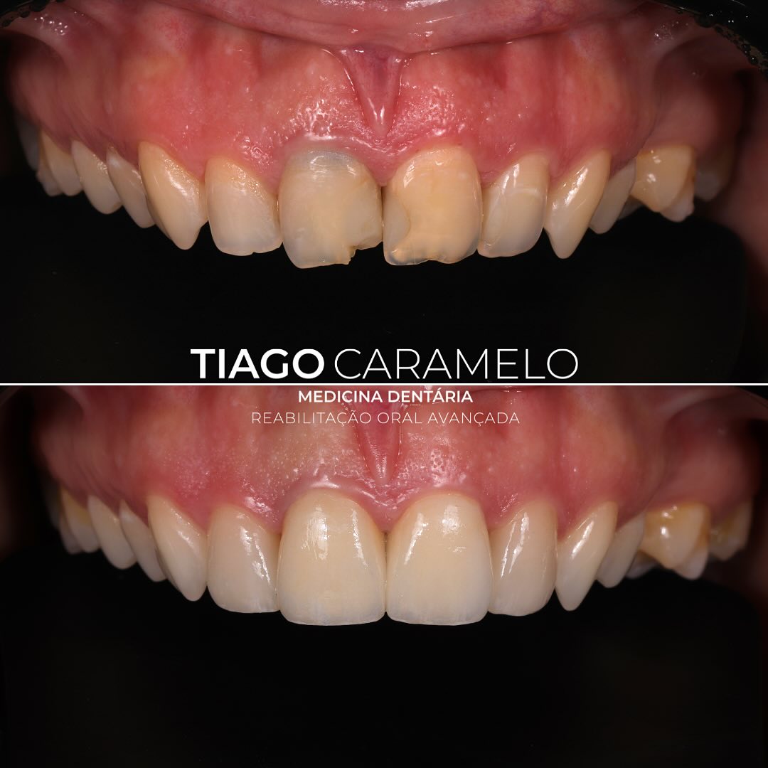 Esta paciente procurou-me por estar descontente com o seu sorriso, particularmente com os dentes anteriores que estavam desvitalizados, com alteração de cor e com fraturas nas restaurações existentes. Posto isto, começámos por fazer branqueamento externo em ambulatório, para posteriormente terminarmos o caso com 2 coroas nos incisivos centrais superiores e com 2 facetas nos incisivos laterais superiores.
É gratificante aperfeiçoar estes sorrisos de forma a restabelecer a confiança e a auto-estima destes pacientes!
Trabalho laboratorial realizado por @sandraumbelino
—————————————————————————————
This patient came to me because she was unhappy with her anterior teeth, which were devitalized, discolored, and had fractures in the existing restorations. Given this, we started with at-home external whitening and then completed the case with two crowns on the upper central incisors and two veneers on the upper lateral incisors.
It is gratifying to enhance these smiles, restoring patients’ confidence and self-esteem!
Laboratory work by @sandraumbelino
#ceramiccrown #ceramicveneers #bleaching #minimalinvasivedentistry #aestheticdentistry #smile #dental #dentalhealth #maloclinic