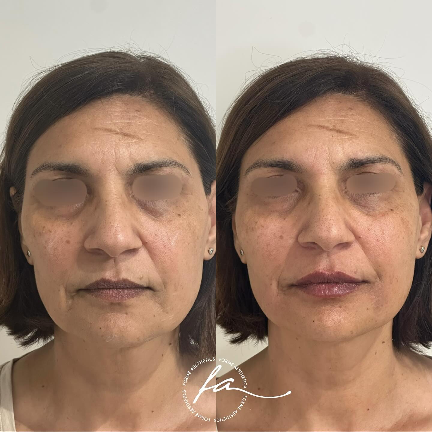 As we age, we naturally lose volume in certain areas of the face, which can lead to a tired or sunken appearance. Through tailored treatments, we can support and enhance your features, restoring balance and a refreshed look—without altering what makes you, you.
Every face is unique, and our approach focuses on subtle, natural-looking enhancements to help you feel confident in your skin. Book a consultation to explore options suited to your needs.
Any surgical or invasive procedure carries risks. Before proceeding, you should seek
a second opinion from an appropriately qualified health practitioner. Results vary.
Consent is always obtained before sharing patient images.
Treatment performed by Stephanie Sirillas RN
