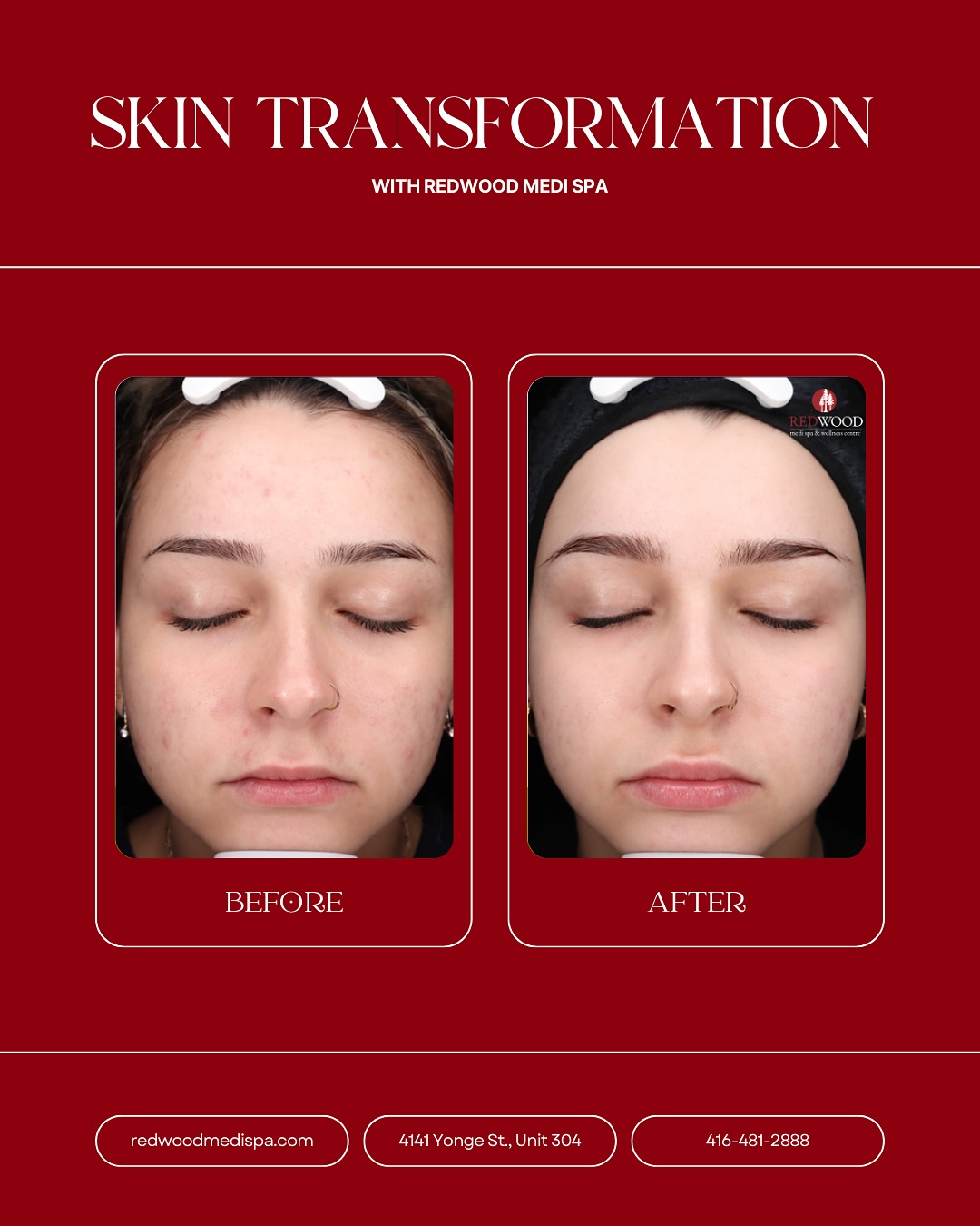 ✨ Swipe for skin transformation ! ✨
From inflamed, congested, textured skin ➡️ smooth, bright & glowing! 💖
Her custom treatment plan:
🔥 Chemical Peel –décongestion & renew
⚡ Picosure & LaseMD – target pigment & texture
🏠 Medical-grade home care – maintain results!
Just LOOK at that transformation! 😍 And we’re just getting started…
👀 Stay tuned for her full journey in our next reel! 🎥💬
Struggling with acne, acne marks and acne scars? Let’s fix it. DM us! 📩
