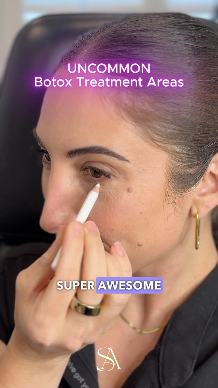 💡Did you know about these three lesser-known but highly effective Botox treatment areas?
👃For the nose, Botox can treat pores, scrunching, and nasal flaring. Treating the area under the nose can help keep the tip elevated at rest.
👁️Botox can also soften the fullness on the lower eyelid that occurs with muscle movement and activation.
😀Finally, treating the jawline and neck bands can inhibit muscle pulling and widening, resulting in a sleeker jawline appearance. #botox #skin #skincare #wrinkles #skincareroutine #xeomin #dysport
