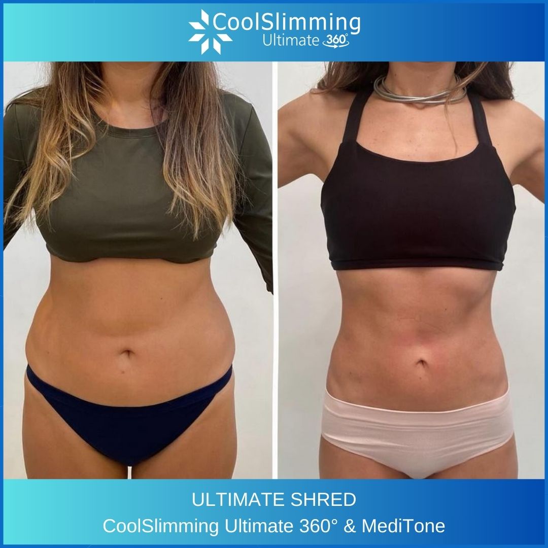 💎 𝘾𝙇𝙄𝙀𝙉𝙏 𝙎𝙐𝘾𝘾𝙀𝙎𝙎 𝙎𝙏𝙊𝙍𝙔 💎 💪🏻 Ultimate Shred Package! 💪🏻
Ultimate Shred utilises our MediTone treatment side by side with CoolSlimming.
This client has had 2 treatments of CoolSlimming Ultimate 360 on the Flanks and Upper and Lower Abs to get rid of fat.
Using the Curve Max and Flex Applicators they are 3 x the Size of other applicators, 3 x the treatment area which means 3 x the Results!
Then 6 treatments of MediTone to build muscle while simultaneously reducing fat – slimming, sculpting, toning and firming.
If you want to give your clients results like these, Contact us now! 📲