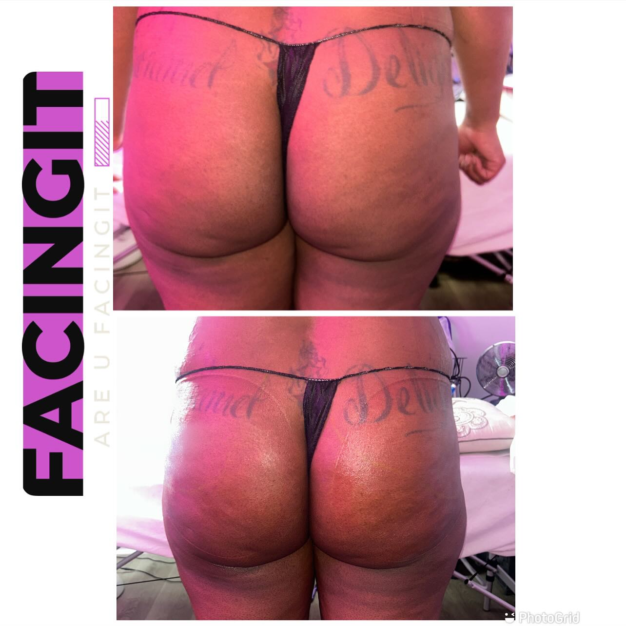 Lifted & Plumb
Body Contouring/body sculpting gets rid of fat cells and reduces the appearance of fat on targeted areas of the body. Whether using heat, cooling, or ultrasound, body sculpting treatments kill fat cells that are then excreted over the amount of session you encounter. See more information and pictures on on business page @_Facingit & at my website AubriaFacingIt.com
Ultrasonic or ultrasound cavitation is the use of ultrasound technology to break down fat cells below the skin. It is a non-surgical method of reducing cellulite and localized fat
Vacuum-therapy stimulates muscles and breaks down cellulite and fatty deposits, which eliminates toxins, therefore improving lymphatic drainage. Vacuum therapy also helps restore the skin’s natural elasticity to smooth the appearance of “orange-peel” dimpling in the thighs and buttocks.
CoolSculpting/ Laser Lipo is a noninvasive, nonsurgical procedure that helps to remove extra fat cells from beneath the skin. As a noninvasive treatment, it has several benefits over traditional surgical fat removal procedures.
Non-Surgical Buttock Lift is a procedure that can add fullness and shape to the backside without anesthesia or incisions & with limited pain and downtime.
〰️No Pain 〰️
〰️No downtime 〰️
〰️Safe Treatment 〰️
〰️4-8 session are advised for best result〰️
〰️Results vary depending on body type 〰️
Follow my business page @_FacingIt & check out some of my work
Website: AubriaFacingIT.com
Are You FacingIT
#facials #bodysculpting #skintightening #beauty #weightloss #laserlipo #facialsatlanta #bodygoals #cavitation #noninvasive #clarkatlanta #lipo #postoptreatment #cardi #facingit #coolsculpting #cellulitereduction #woodtherapy #minklashes #radiofrequency #facialatlanta #lasorlipo #nonsurgical #vacuumtherapy #explorepage #postop #spa #lymphaticdrainage #collegepark #bodycontouringatlanta