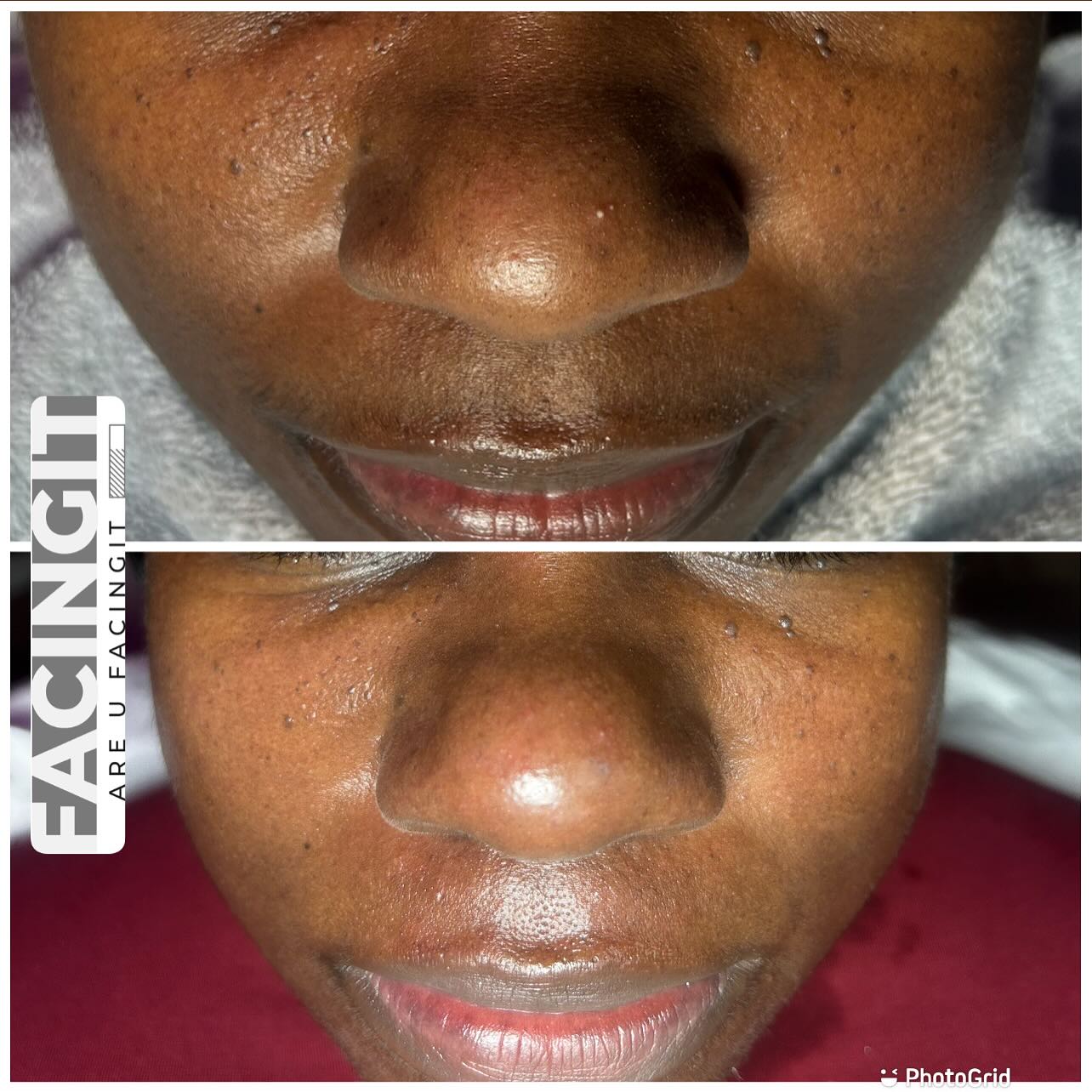 Hello My name is Aubria your favorite esthetician and I offer spa needs services. Such as Facials, Waxes, Body Contouring, Yoni Steam,Sauna Blanket and more. My shop is located off Washington Road close to the East Point Train Station end. My Instagram ,TikTok, and Facebook is @_FacingIT and my website is www.AubriaFacingIT.com Come check out my page and book your next service with me. located off Washington Road close to the East Point Train Station end. My Instagram ,TikTok, and Facebook is @_FacingIT and my website is www.AubriaFacingIT.com Come check out my page and book your next service with me.
#dermaplaningfacials #facialatlanta #atlantaspa #metroatlanta #clearskin #explorepage #vacuumtherapy #facials #foryoupage #eastpoinga #blackesthetician #atlantasouthside #Atl #atlantabraids #facialsatl #spaday #collegeparkga #products #hairremoval #skinproducts #facialtreatment #blackowned #estheticianatlanta #facingit #extractions #atlanta #naturalskincare #blackheadremoved #hydrafacial #skin