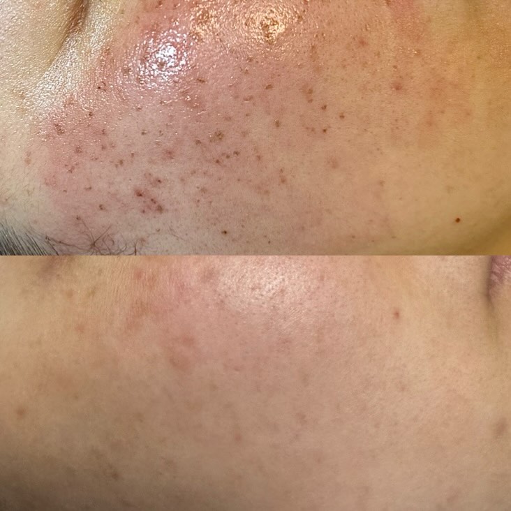 ✨ Glowing Skin, Real Results! ✨
Look at this incredible skin transformation after just ONE session of AOPT IPL at Armin’s Beauty Affair! The before & after speaks for itself—clearer, smoother, and more radiant skin in just 4 weeks!
Struggling with acne scars, pigmentation, or uneven skin tone? Let us help you achieve your dream skin with our advanced IPL treatments right here in Halifax!
📍 Limited spots available—DM us to book your session today! #HalifaxBeauty #SkinGoals #IPLResults #halifaxskincare
