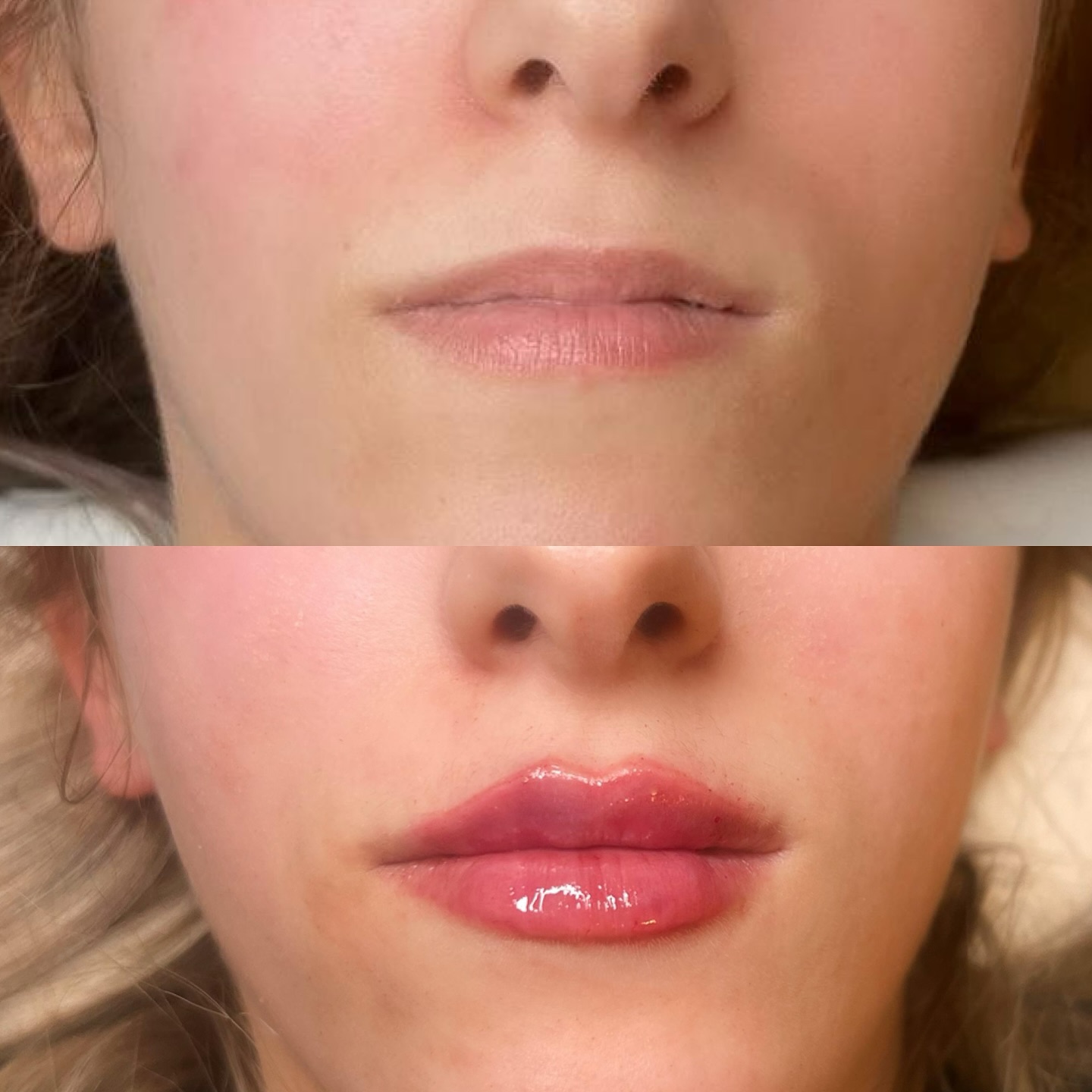 Lips 👄👄👄 1ml en 2 séances ✨ Douce transformation pour un résultat harmonieux et élégant 💋