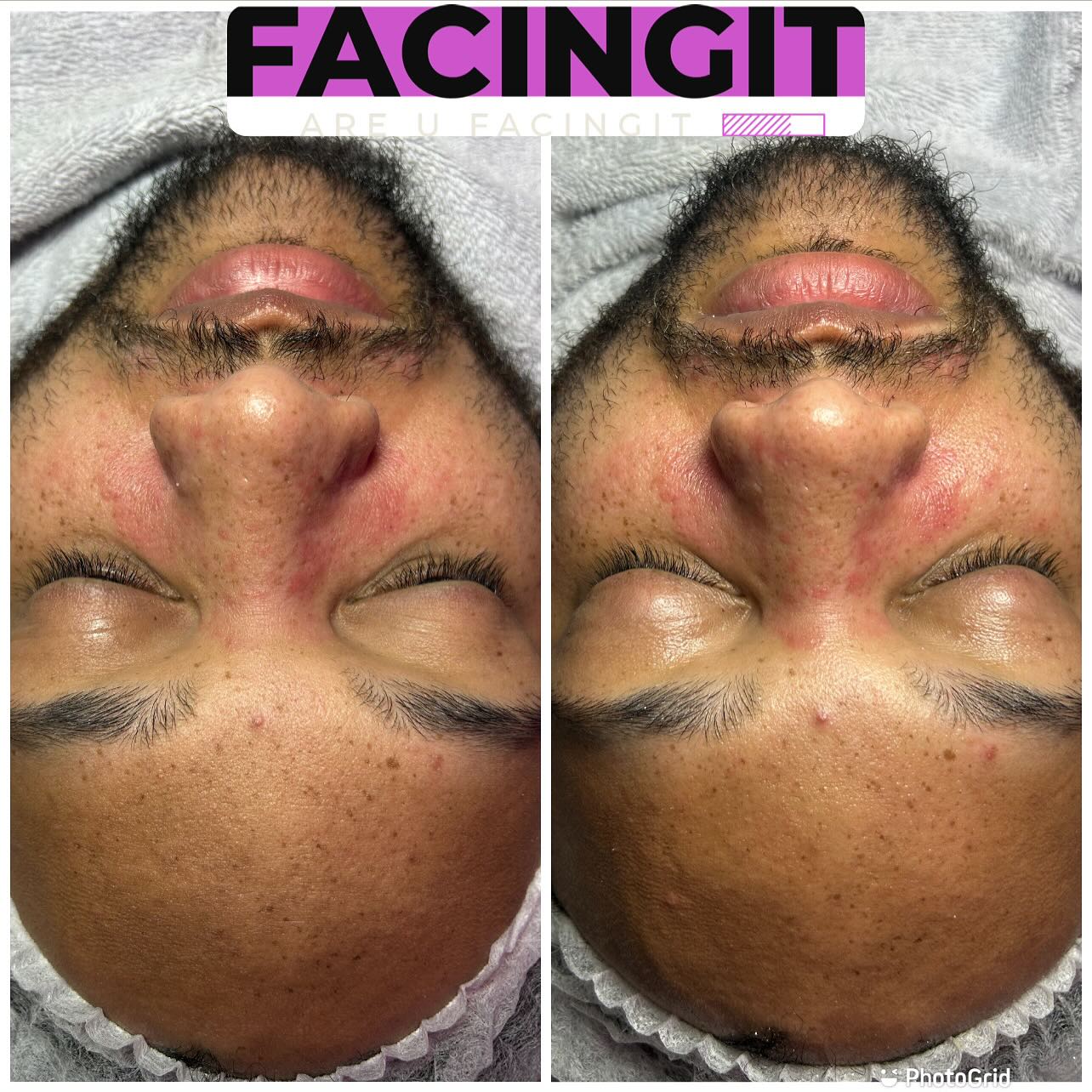 Hey yal wassup check out some of my reviews. My goal is to help you achieve your healthy skin care. Red bumps, acne, dark spots, dead skin, rough skin , dry skin, extractions, black heads exc. can clog up pours. Let me help treat your face to your desire look. Are You FacingIT
#facials #bodysculpting #skintightening #collegepark #weightloss #laserlipo #skincare #bodygoals #cavitation #atlantabraids #campcreek #lipo #atlantafacials #nonplasticsurgery #cavitation #eastpointga #foryoupage #woodtherapy #fatloss #radiofrequency #facialatlanta #southsideofatlanta #nonsurgical #vacuumtherapy #facingit #fyp #spa #explorepage #bodysculpting #bodycontouringatlanta
