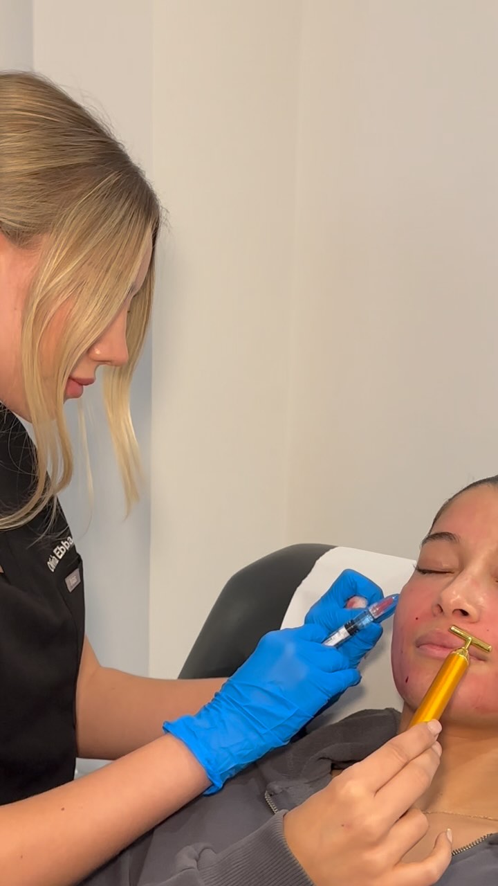 Some skin boosting treatments done for Nada 💫
🧬Microneedling with exosomes
• Collagen & Healing – Accelerates repair, boosting collagen and elastin.
• Smooth & Even – Reduces wrinkles, scars, and pigmentation.
• Hydrated Glow – Strengthens barrier for moisture and radiance.
• Cell Renewal – Enhances regeneration and skin vitality.
🐠Polynucleotides under the eyes
• Hydrates & Repairs – Restores elasticity and smooths crepiness.
• Brightens & De-Puffs – Reduces dark circles and puffiness.
• Firms & Rejuvenates – Boosts collagen for smoother, plumper skin.
💧Profhilo
• Hydrates & Plumps – Deeply moisturizes for elasticity and glow.
• Firms & Lifts – Boosts collagen for smoother, tighter skin.
• Refines & Rejuvenates – Improves texture and reduces fine lines.
#LondonAesthetics #SkinRejuvenation #MicroneedlingExosomes #Polynucleotides #NaturalEnhancement #UnderEyeTreatment #LondonSkinClinic #AntiAgingLondon #SkinRevitalization #RegenerativeAesthetics #HealthySkinLondon