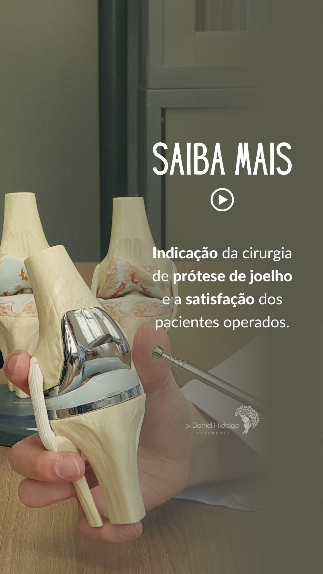 😩Quando o desgaste do joelho provoca dor constante, atrapalha as atividades do dia a dia e os tratamentos não cirúrgicos já não funcionam mais, a cirurgia para colocar uma prótese pode ser a melhor solução.
O mais importante: a maioria dos pacientes fica muito satisfeita com o resultado, sentindo menos dor, mais liberdade de movimento e qualidade de vida de volta!😃
#PróteseDeJoelho #Ortopedia #CirurgiaDoJoelho #Artrose #QualidadeDeVida