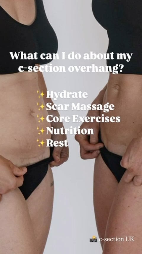 One of the most common questions I get asked in clinic everyday….
#physiotherapy #thirsk #wellbeing #physiotherapy #emmaclairephysiotherapy womenshealth