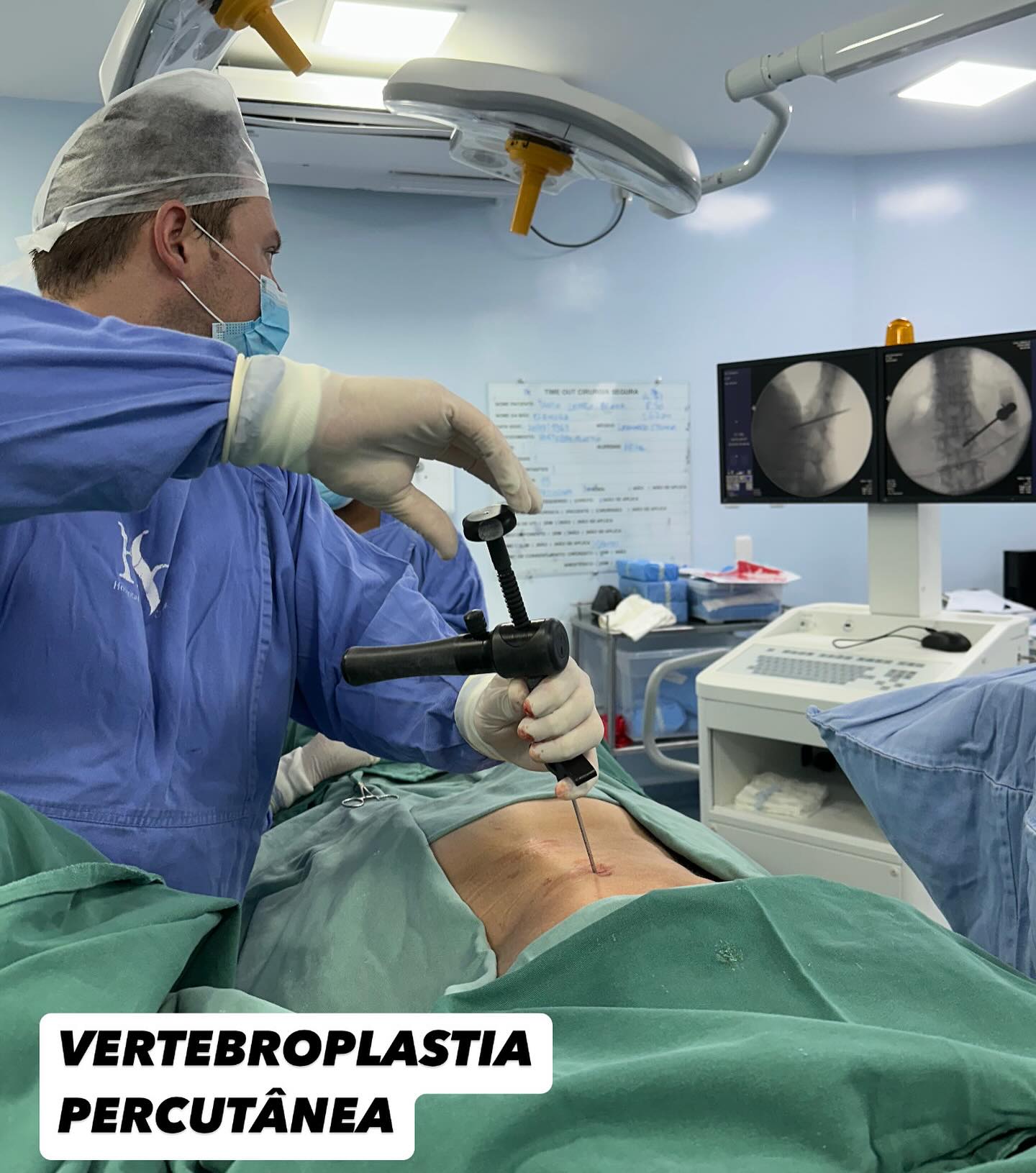 A Vertebroplastia Percutânea é uma técnica minimamente invasiva utilizada para o tratamento de algumas fraturas da coluna vertebral - especialmente as fraturas causadas por osteoporose.
É um procedimento seguro, pouco invasivo, realizado através de uma mínima incisão, e permite alta hospitalar ao paciente no mesmo dia.
Mais informações em doutorleonardo.com.br